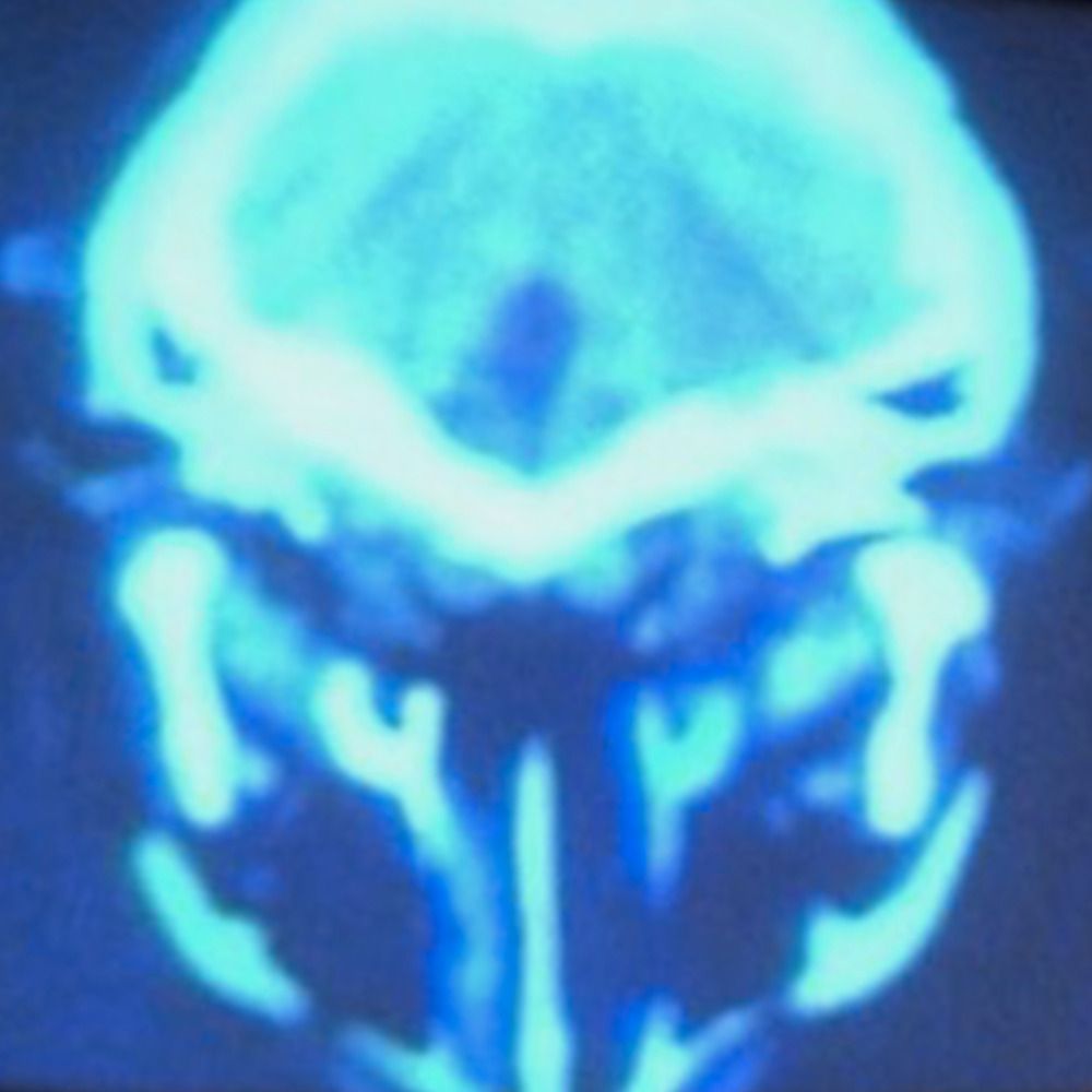 Pineal Scream