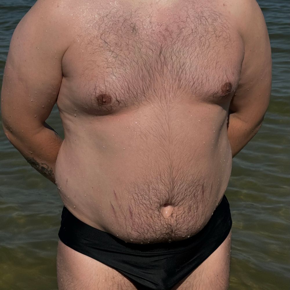 vitiligoboy