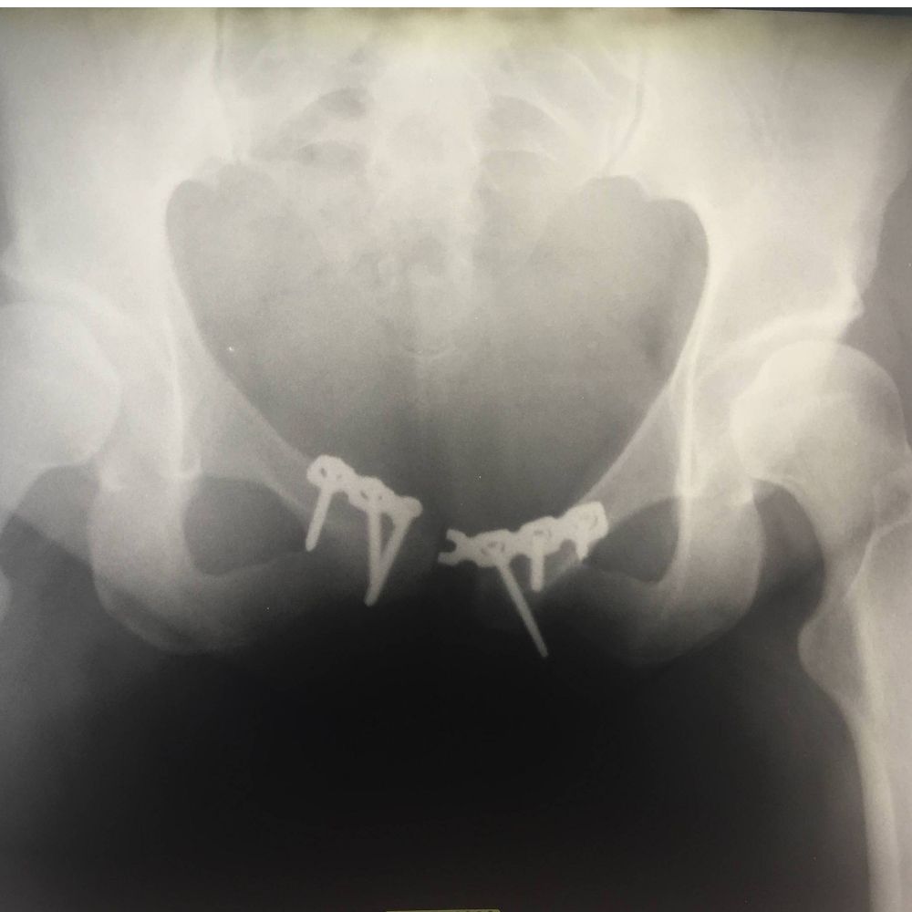 BionicPelvis - Wendy Crockett