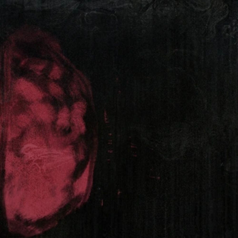 pineal_clot