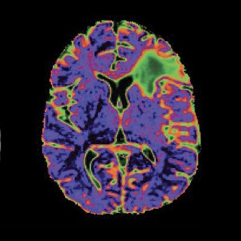 UCSF Neurosurgery