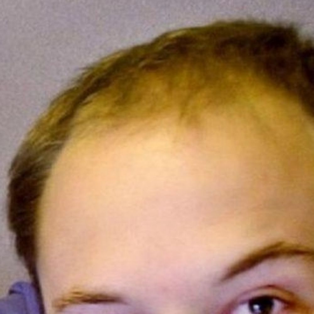 Elon's Hair Plugs