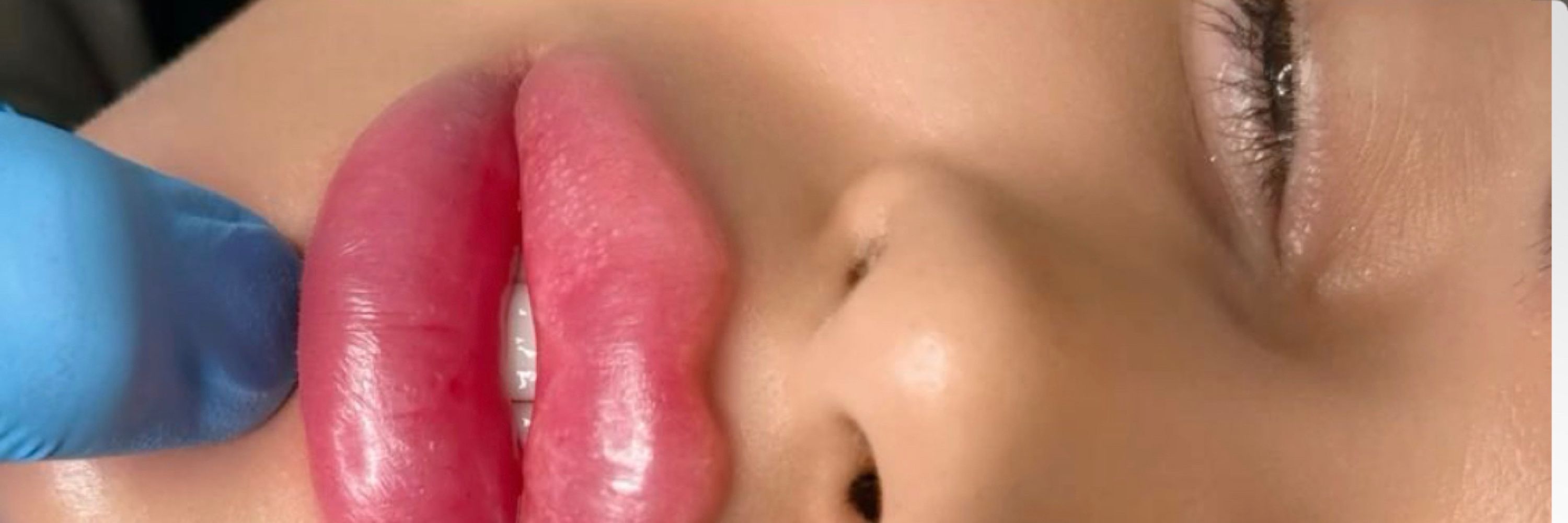 Scott’s Dermal fillers