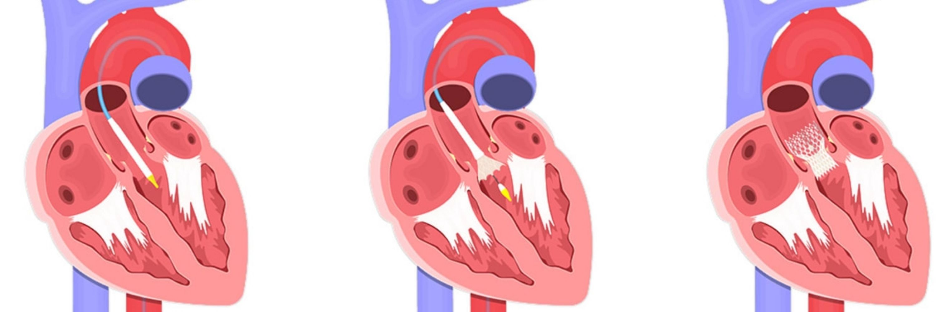 Meg D, the CHF NP