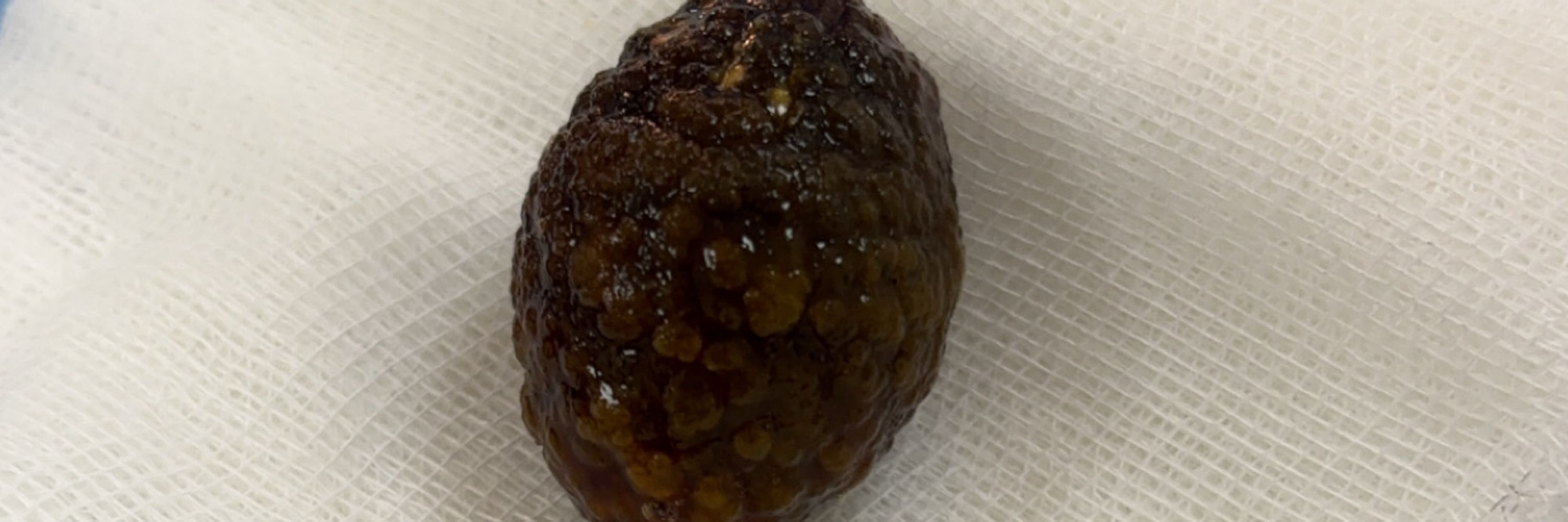 Dr Gallbladder