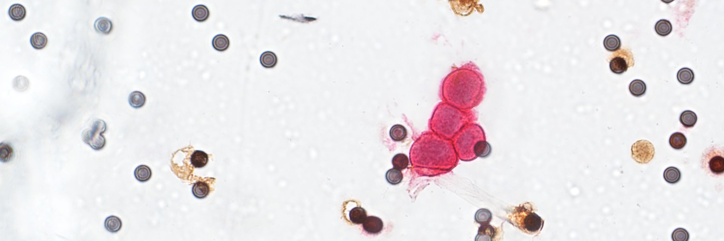 ScreenCell | Circulating Tumor Cells (CTCs) Test