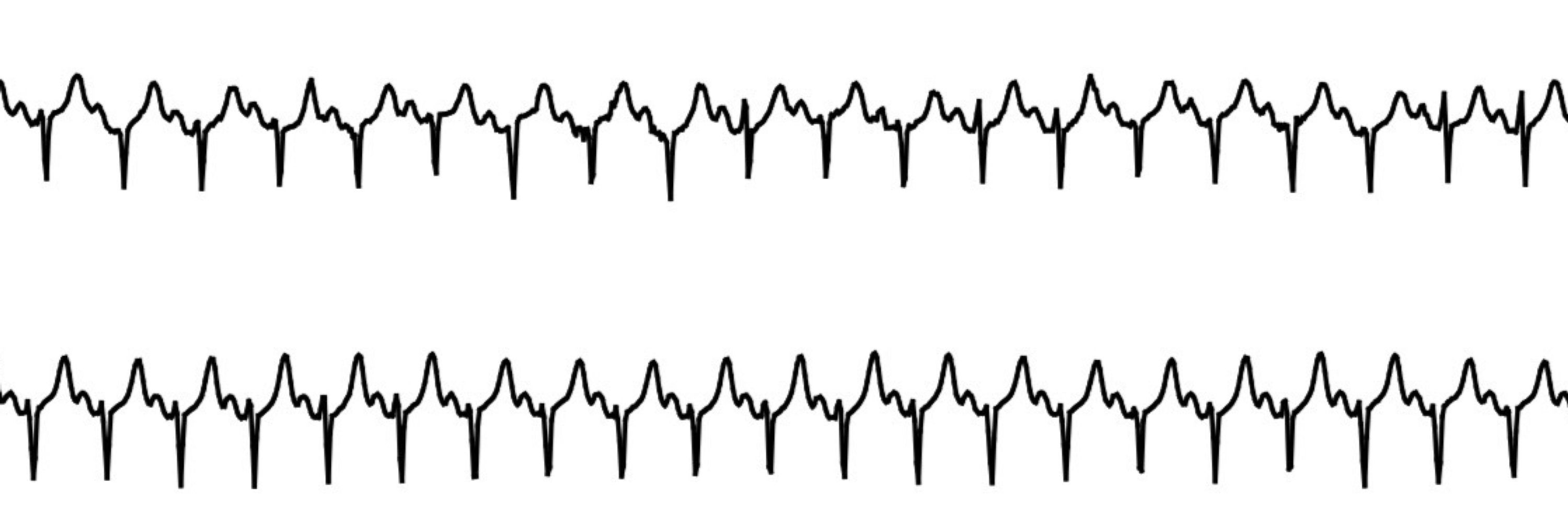 sinus tach