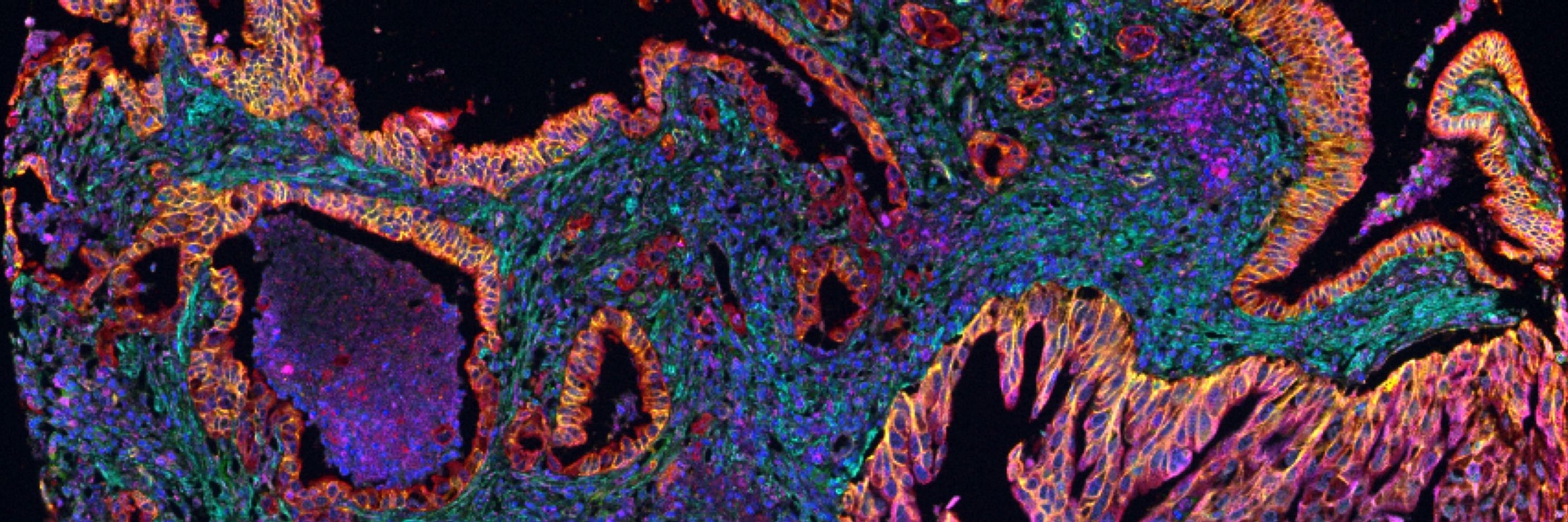 Personalised Cancer Therapeutics