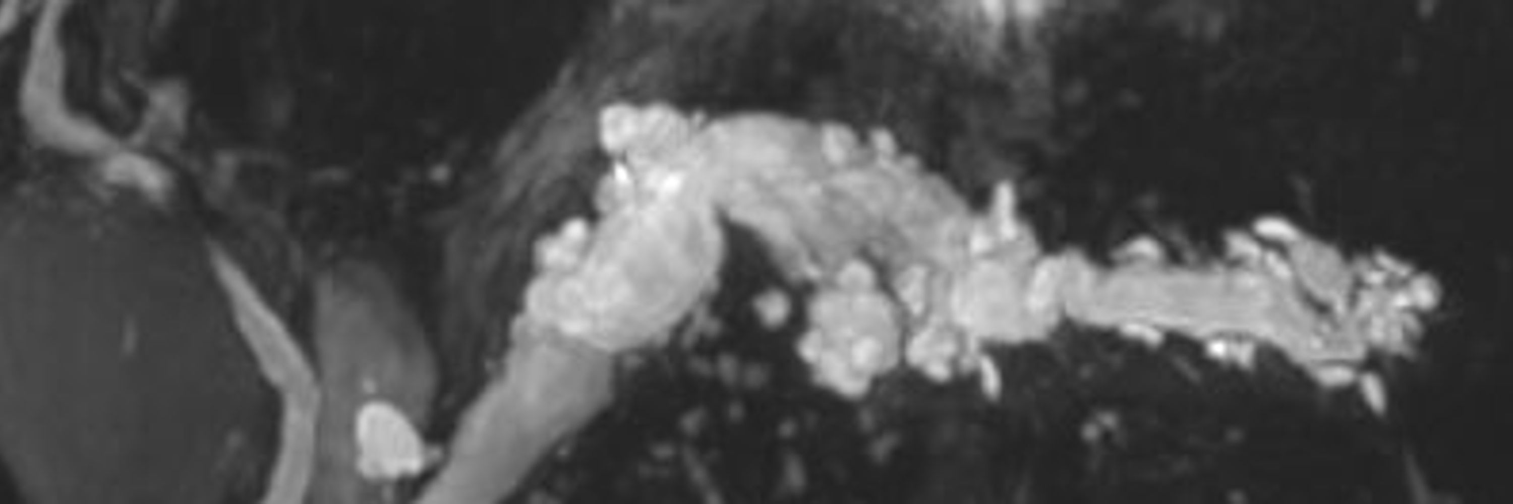 SAR Pancreatic Adenocarcinom DFP