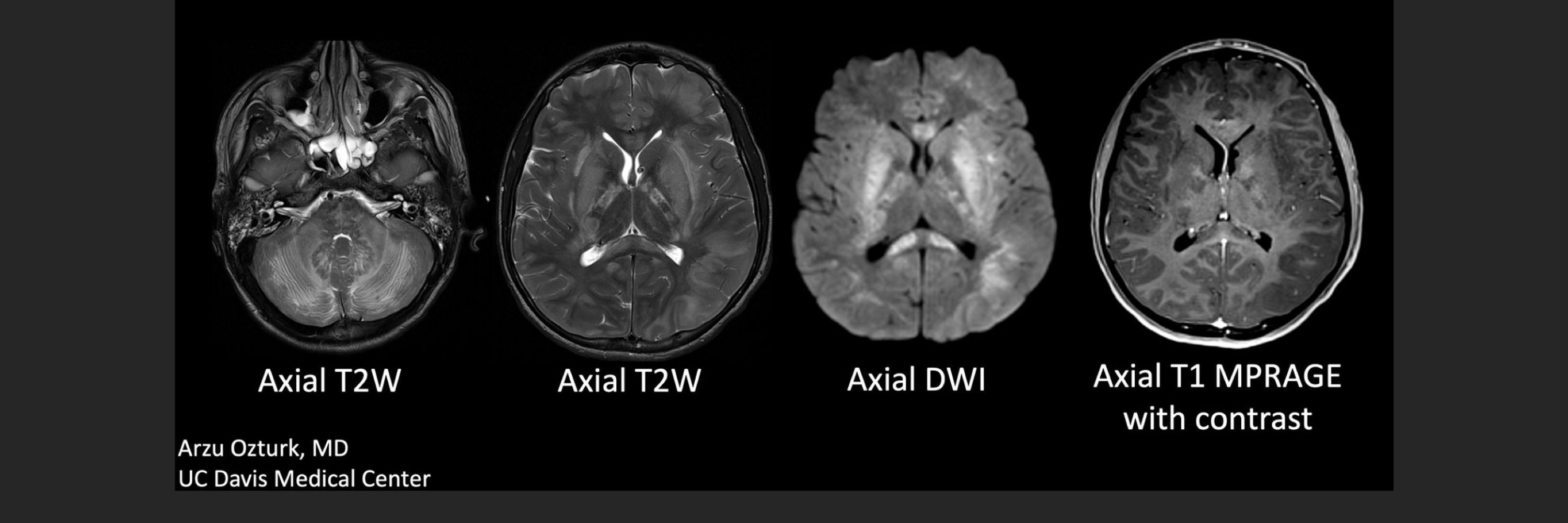 American Society of Pediatric Neuroradiology