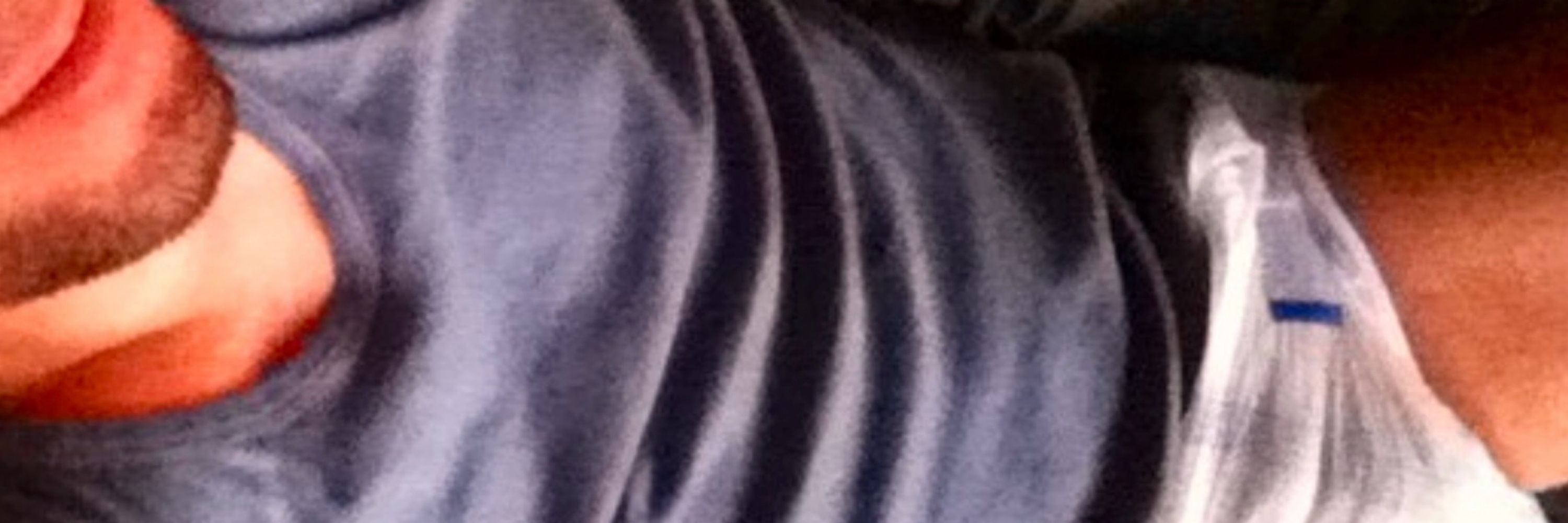 SF_ABDL