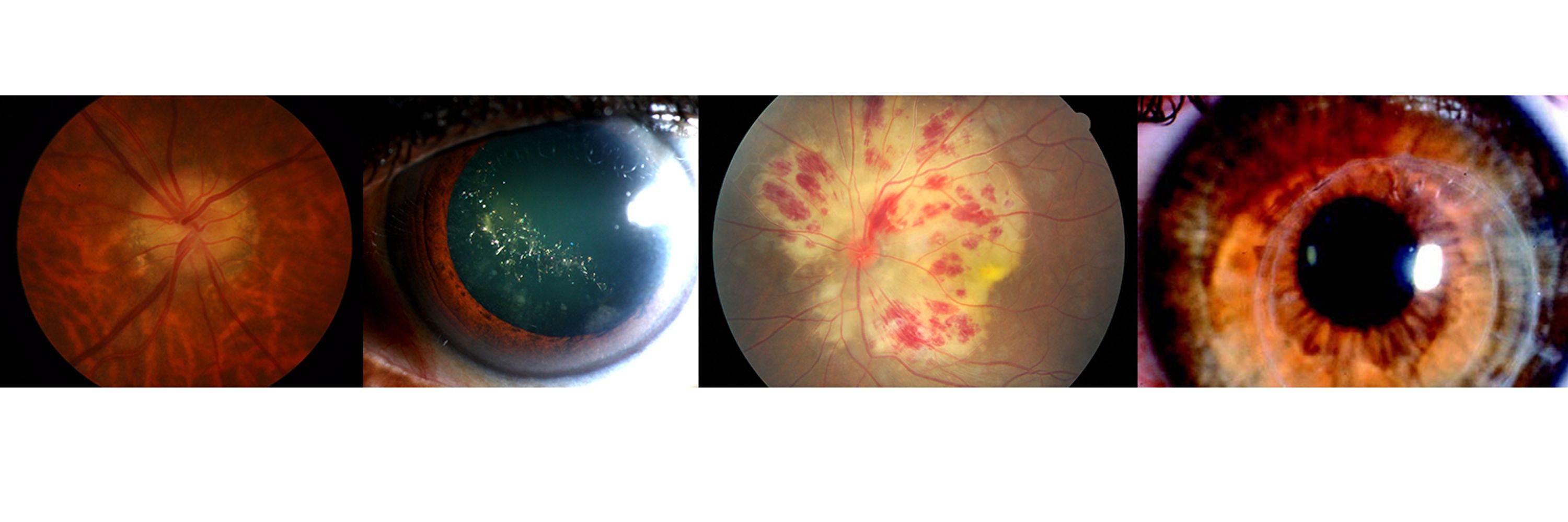 Canadian Journal of Ophthalmology