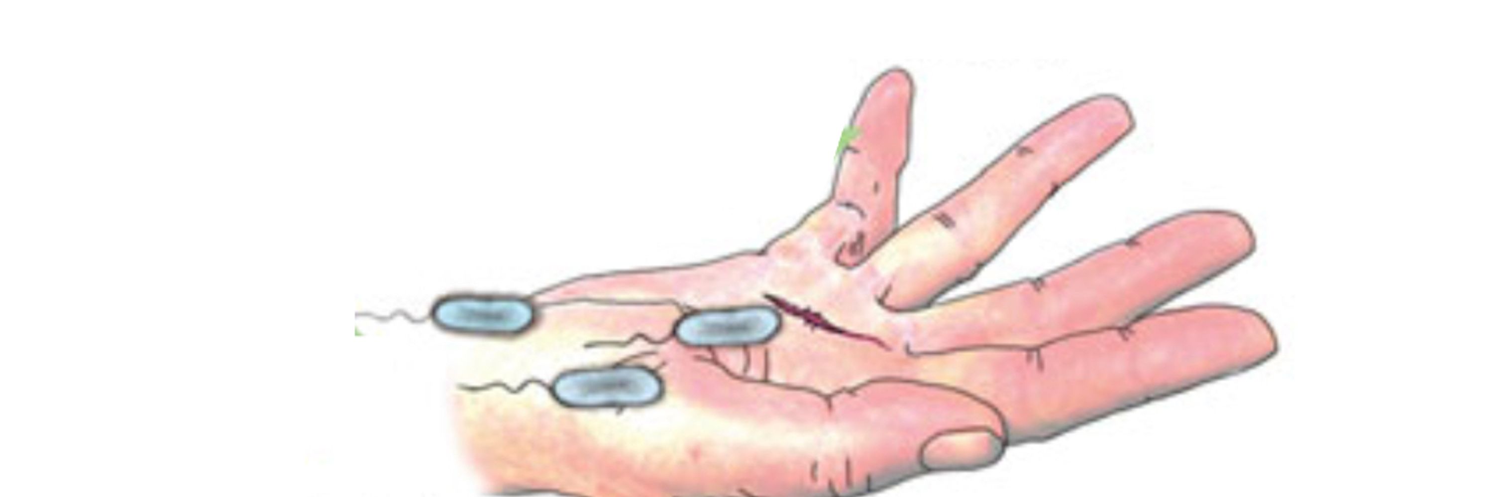 Vibrio Vulnificus