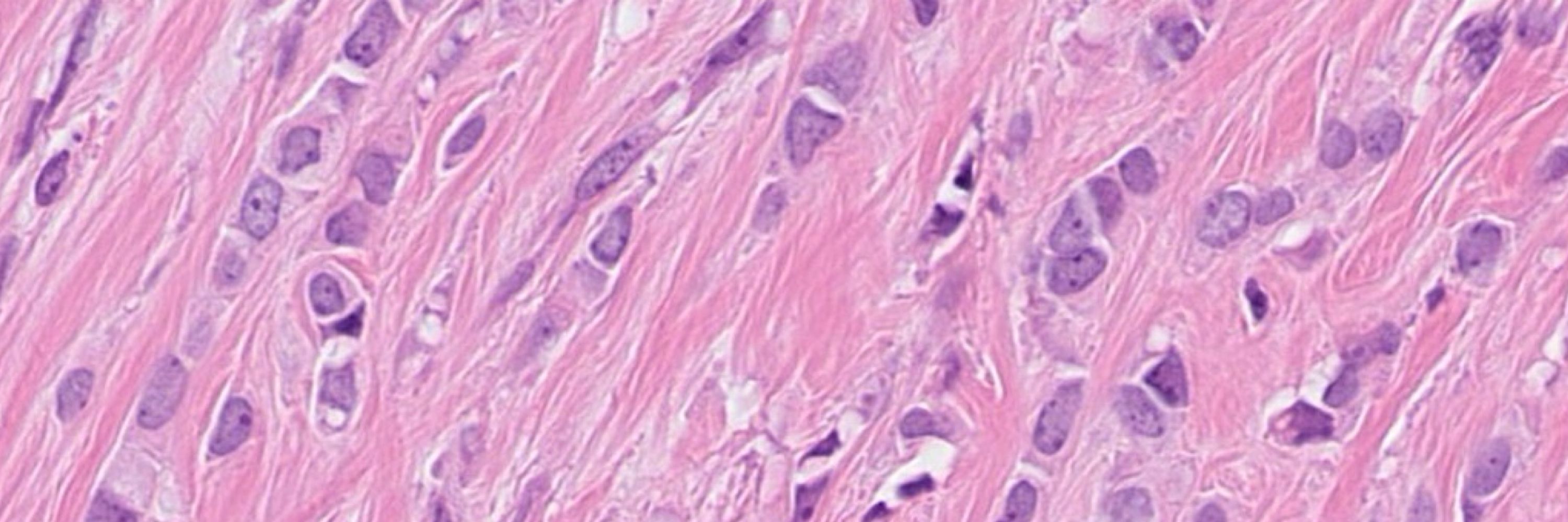 European Lobular Breast Cancer Consortium