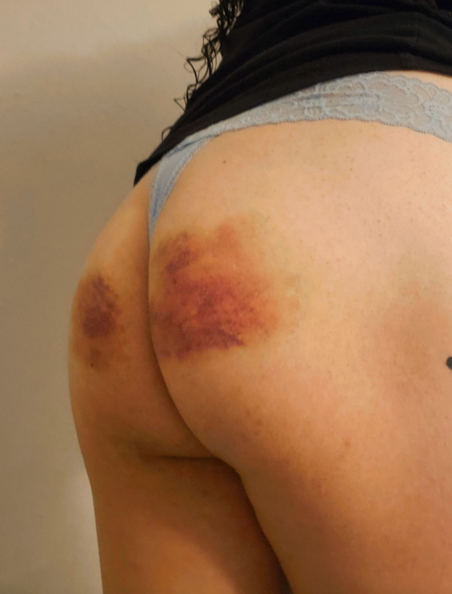 My ass with bruises on both of my cheeks from doing impact play sessions. I'm wearing a black shirt with a light blue lace thong