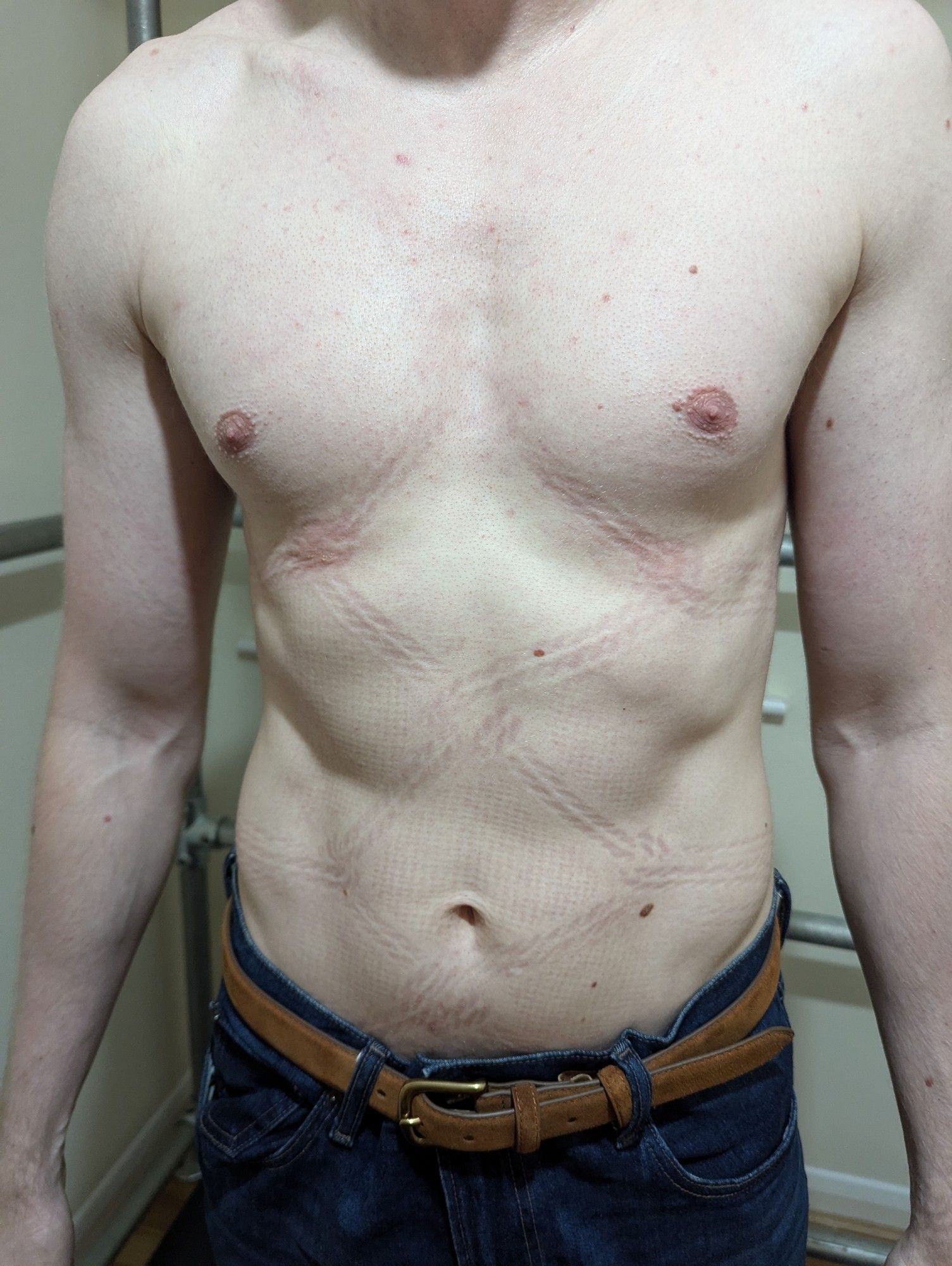 A shirtless guy with rope marks over his chest and stomach