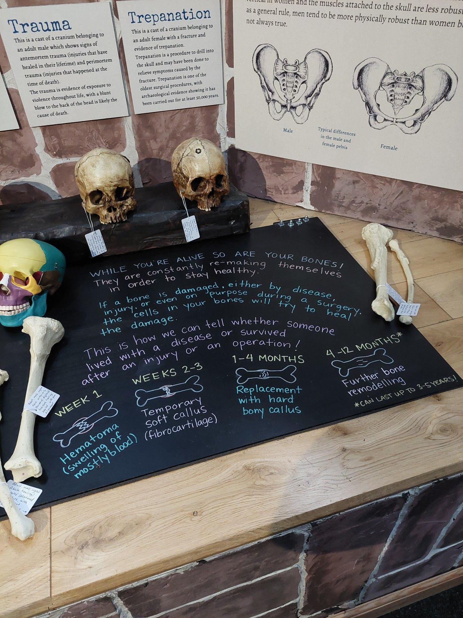 Half of a black chalkboard like surface on a wooden worktop. There are (replica) skulls and bones with labels on.

In handwritten text it says: WHILE YOU'RE ALIVE SO ARE YOUR BONES! They are constantly re-making themselves in order to stay healthy.

If a bone is damaged, either by disease, injury, or even on purpose during a surgery, the cells in your bones will try to repair the damage. This is how we can tell whether someone lived with a disease or survived after an injury or an operation!

There are then little sketches of cartoon bones at various stages of healing. 

WEEK 1
Hematoma (Swelling of mostly blood)

WEEKS 2-3
Temporary Soft callus (fibrocartilage)

1-4 MONTHS
Replacement with hard bony callus

4-12 MONTHS*
Further bone remodelling
*CAN LAST UP TO 3-5 YEARS!