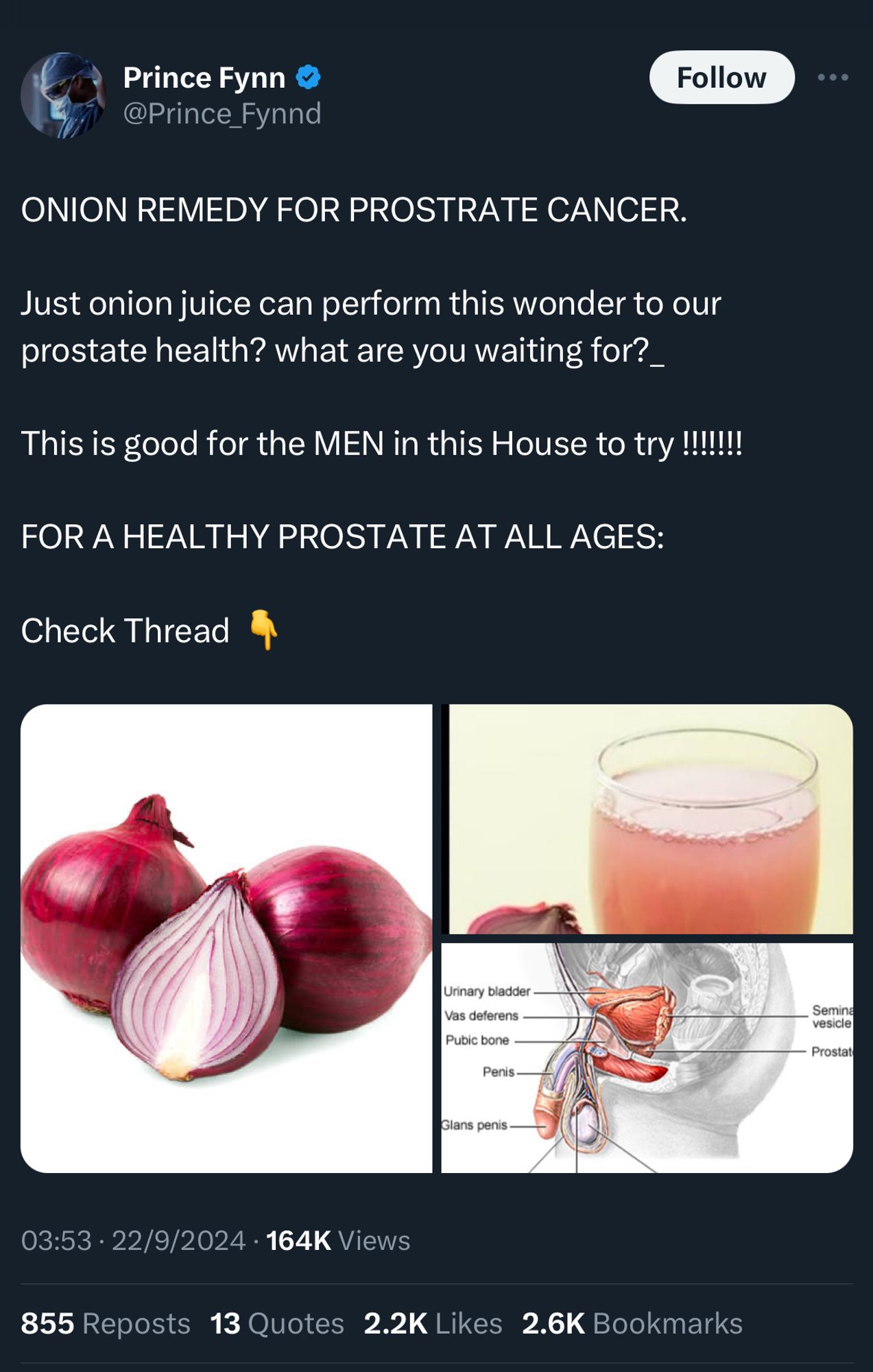 Prince Fynn @Prince_Fynnd

ONION REMEDY FOR PROSTRATE CANCER.
Just onion juice can perform this wonder to our prostate health? what are you waiting for?
This is good for the MEN in this House to try !!!!!
FOR A HEALTHY PROSTATE AT ALL AGES:
Check Thread

03:53 • 22/9/2024 • 164K Views
855 Reposts 13 Quotes 2.2K Likes 2.6K Bookmarks