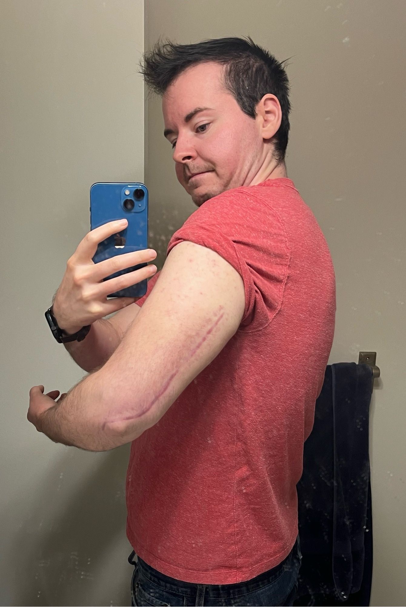 a selfie showing off a healed badass scar from arm surgery