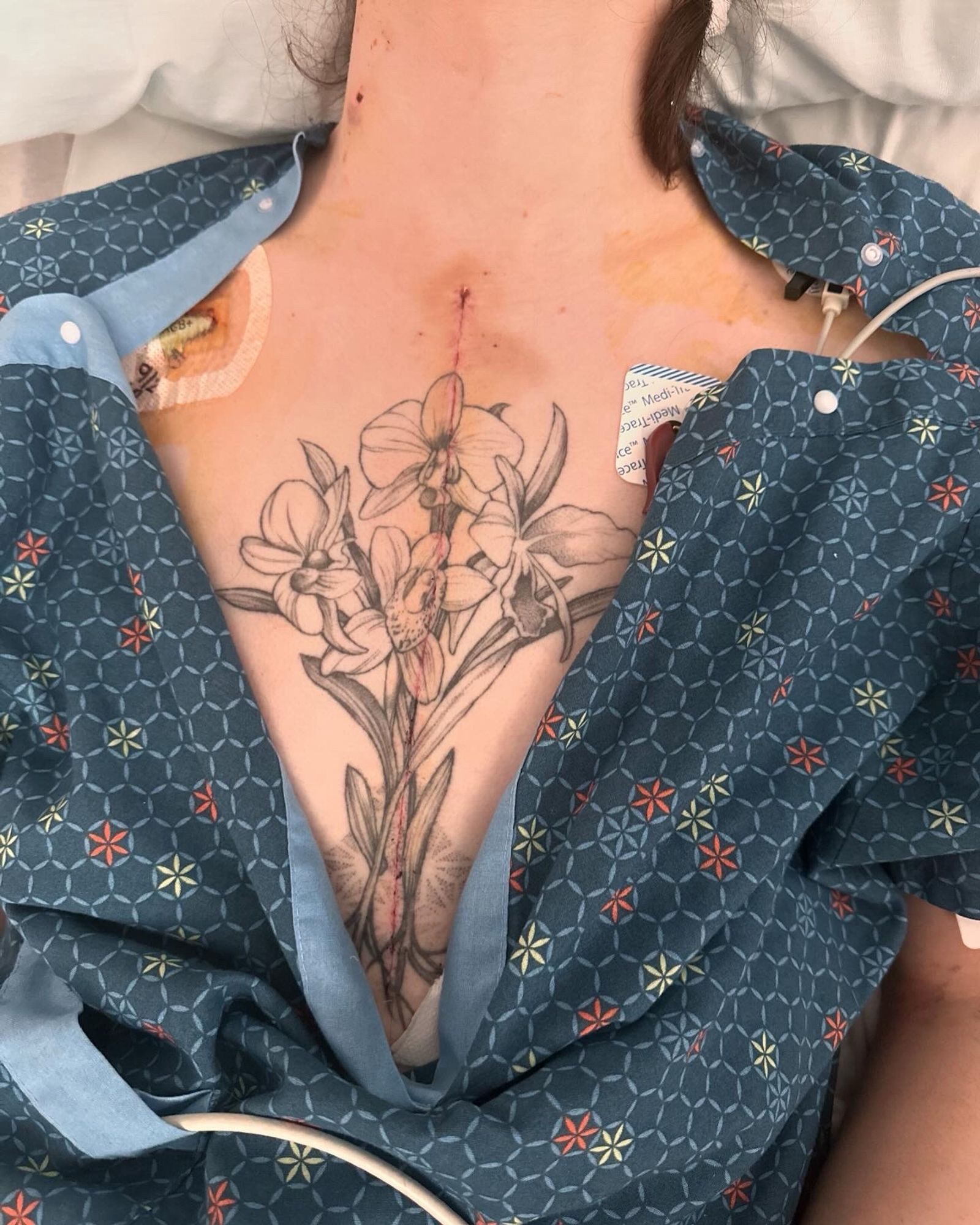 a picture of my chest after open heart surgery with a thin incision going through my tattoo