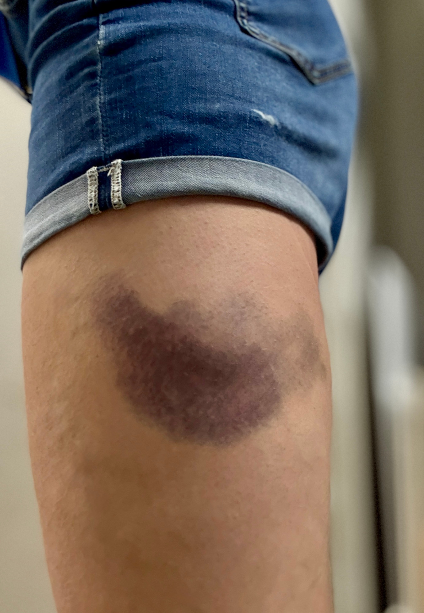 my left leg with a respectable bruise that still hurts like hell