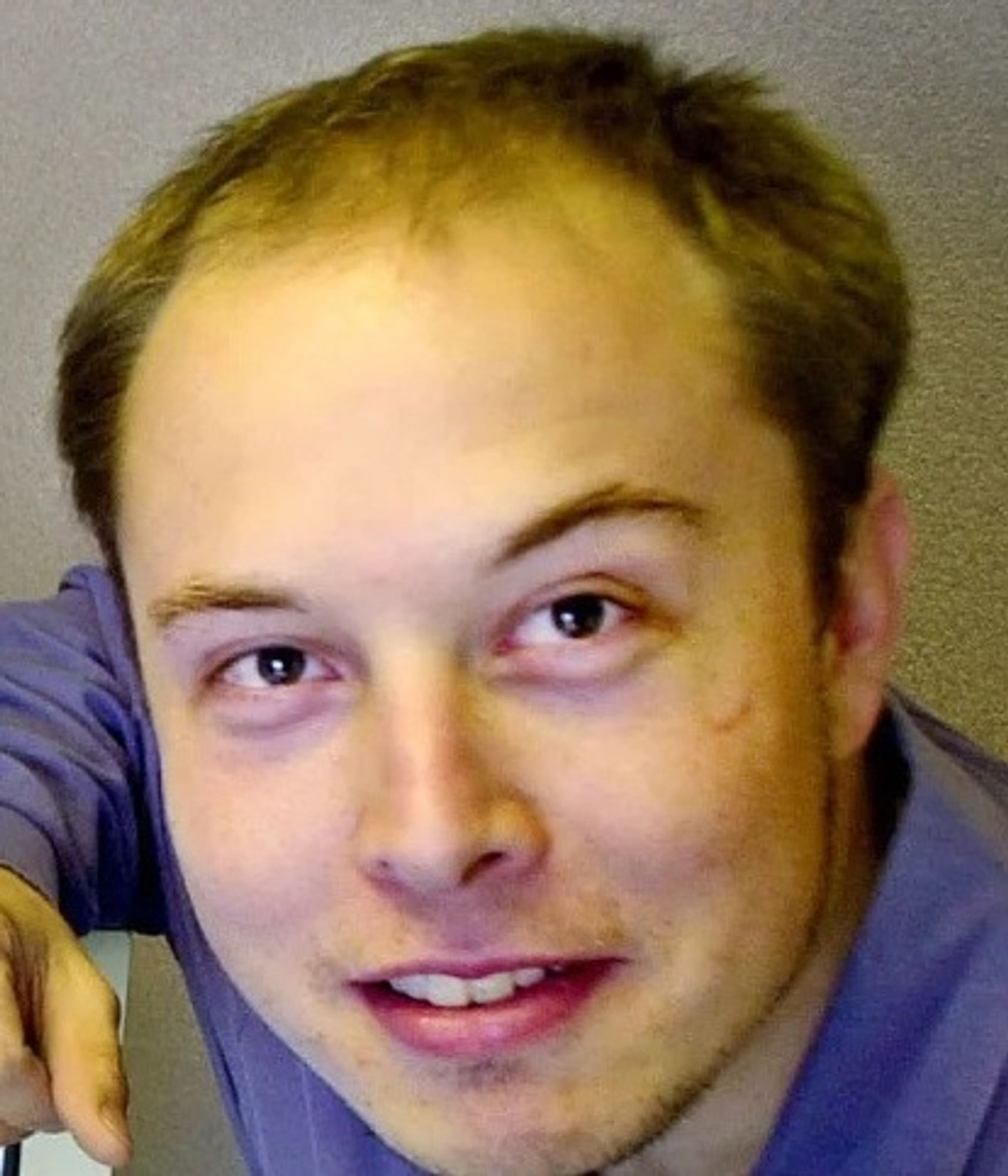 Musk going bald before he was fired from PayPal. Photo from the Associated Press. Seems some of Musk's physical features are not the result of genetics.