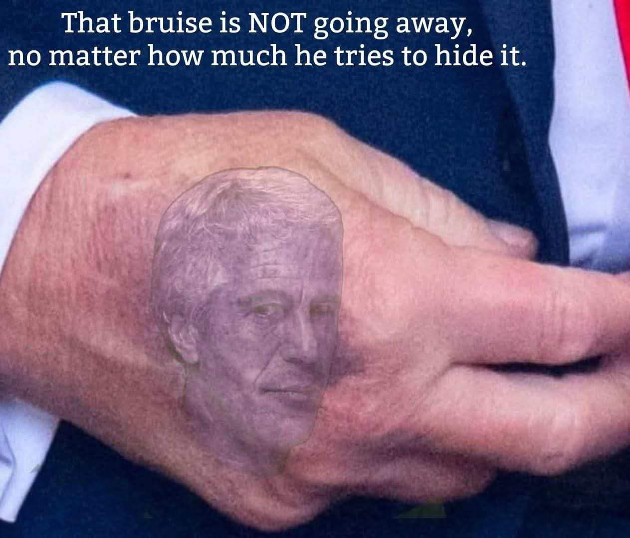 That bruise is NOT going away, no matter how much he tries to hide it.
Picture of Epstein‘s face in the bruise