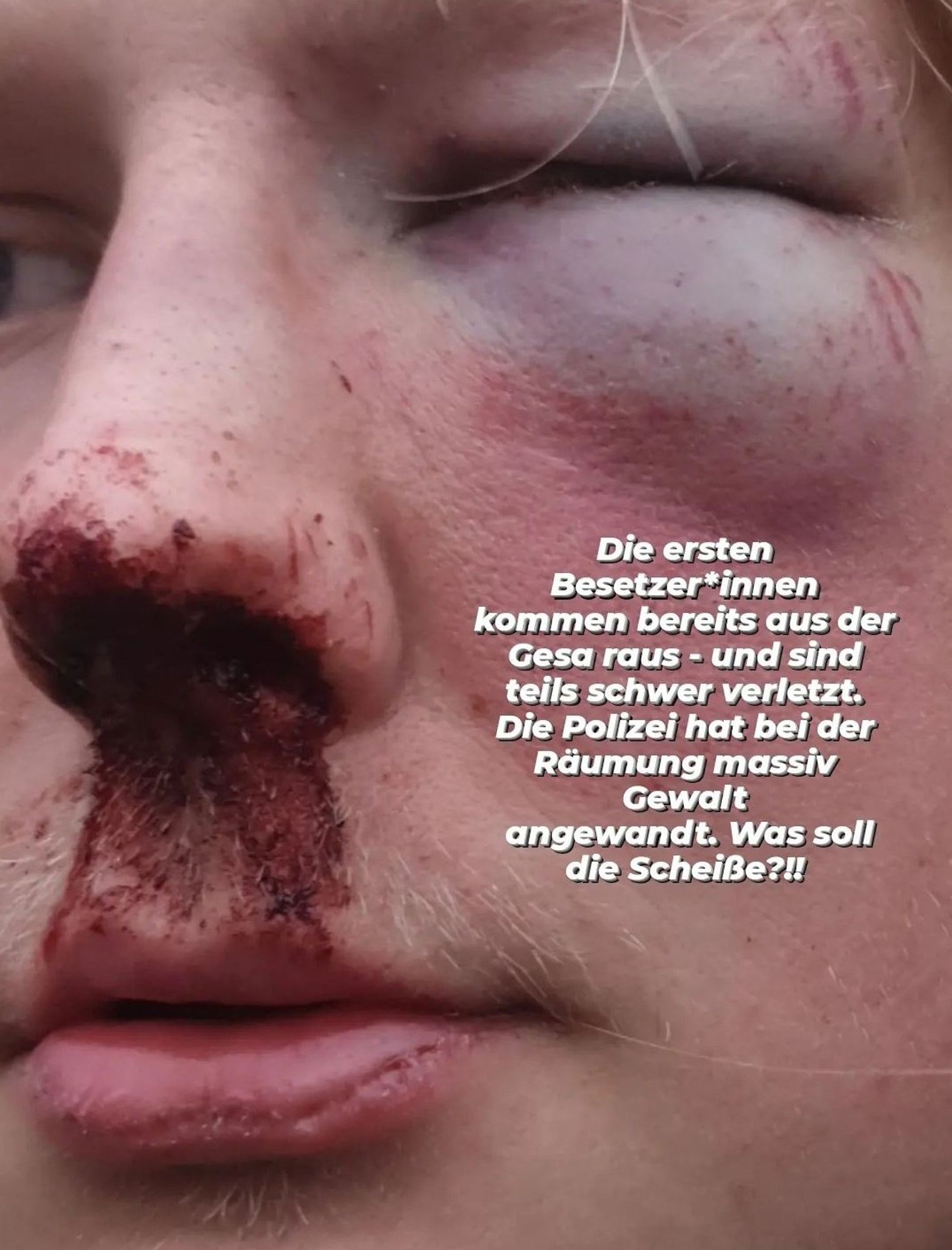 Gesicht im Close up mit zugeschwollenem Auge und blutender Nase, Text dazu: teils schwer verletzt, Polizei hat bei der Räumung massiv Gewalt angewandt