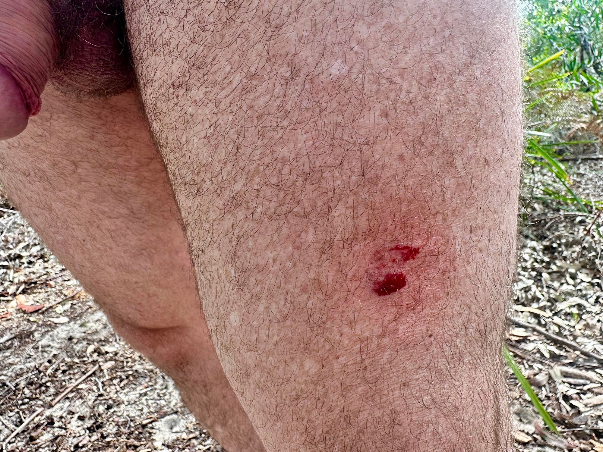 Injured my leg on a jagged branch that was jutting out into a path.