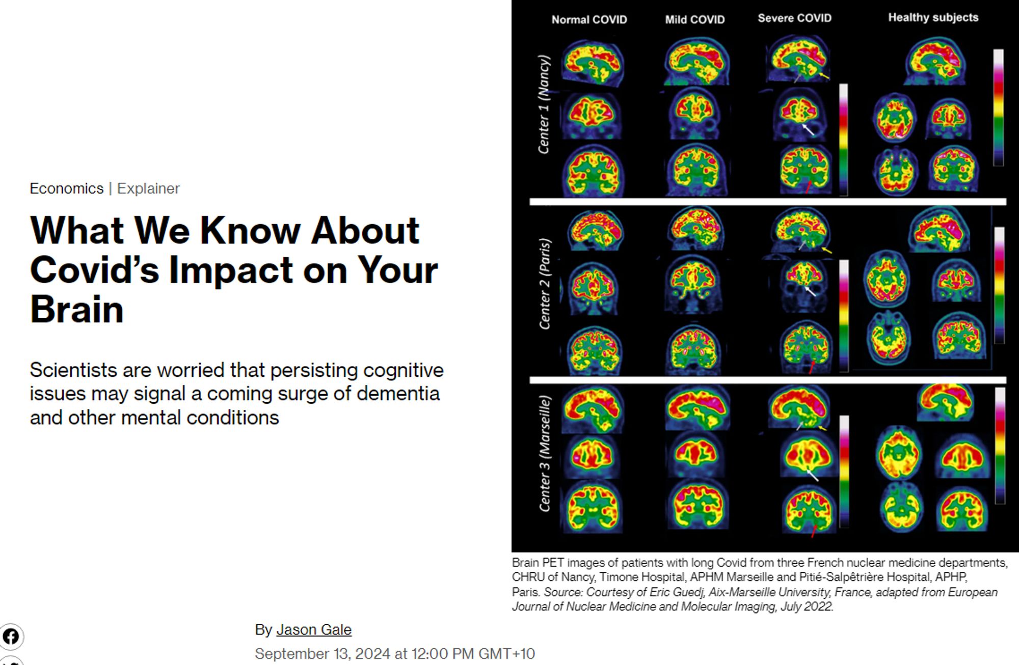 What We Know About Covid’s Impact on Your Brain

Scientists are worried that persisting cognitive issues may signal a coming surge of dementia and other mental conditions

Brain PET images of patients with long Covid from three French nuclear medicine departments, CHRU of Nancy, Timone Hospital, APHM Marseille and Pitié-Salpêtrière Hospital, APHP, Paris.Source: Courtesy of Eric Guedj, Aix-Marseille University, France, adapted from European Journal of Nuclear Medicine and Molecular Imaging, July 2022.

By Jason Gale
September 13, 2024 at 12:00 PM GMT+10