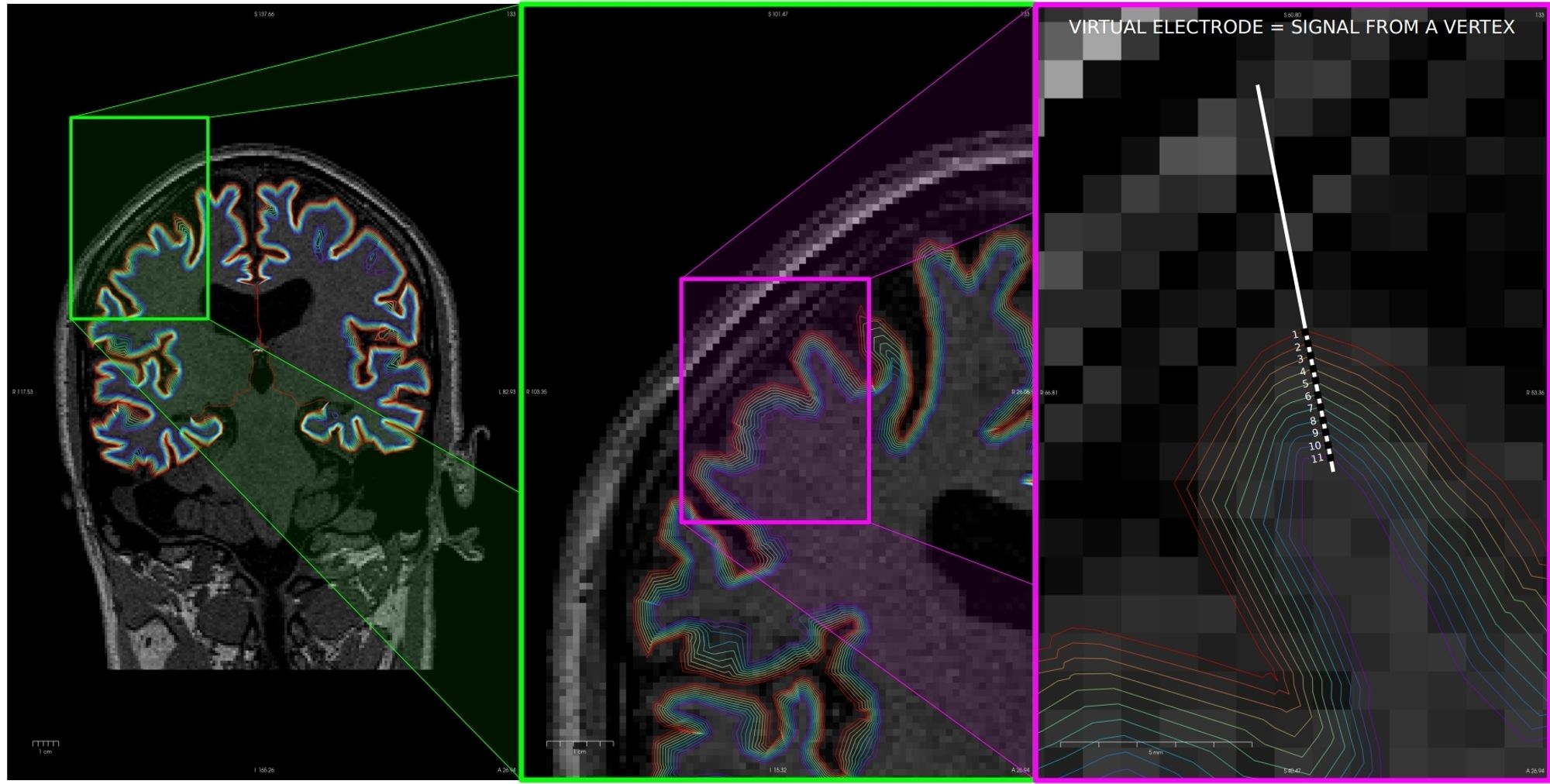 Holy heck and frick! Can you believe that you can have a non-invasive depth electrode-like signal from the whole brain? You just need to have a super good quality MEG.