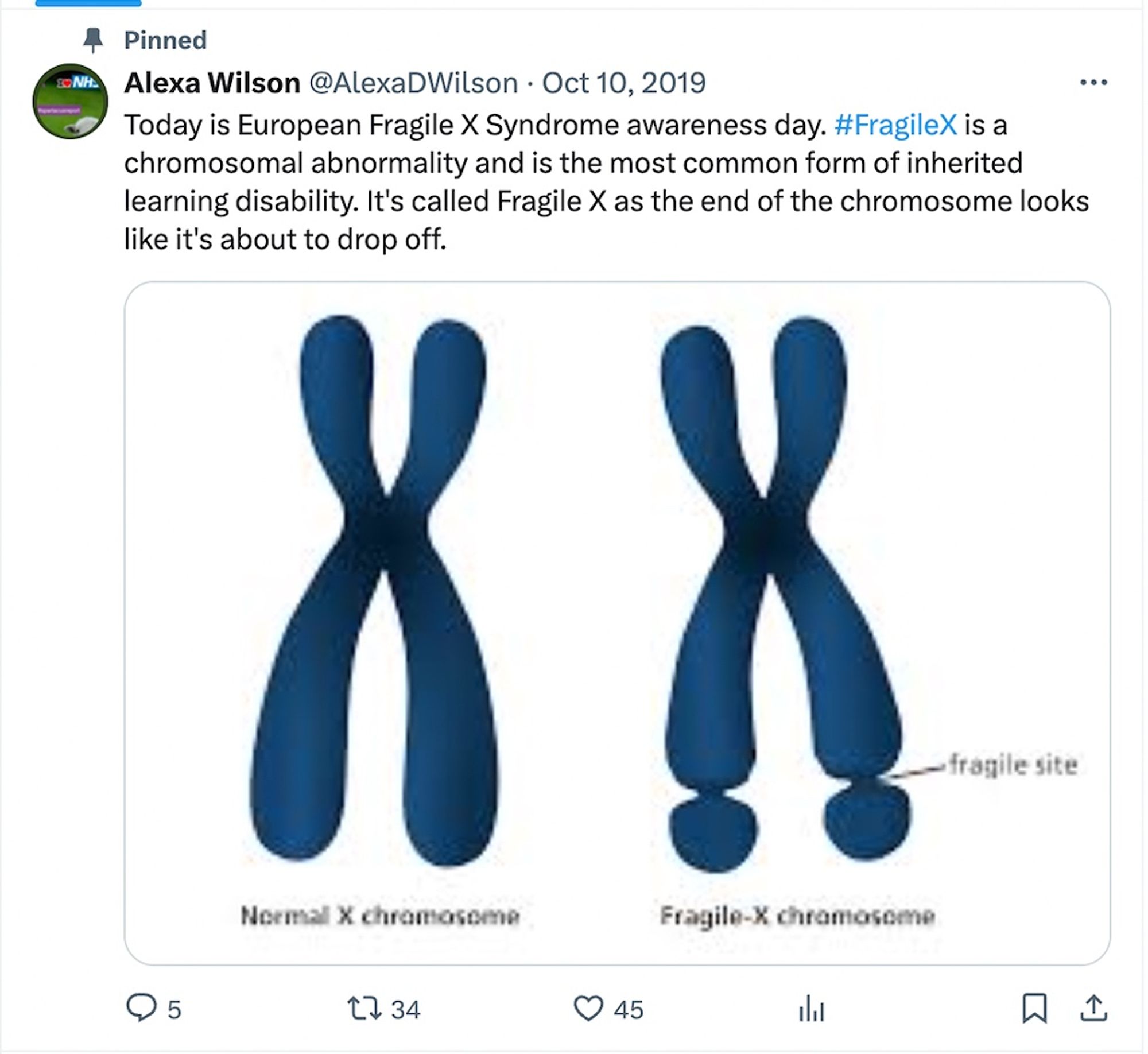 FX is a chromosomal abnormality and is the most common form on inherited learning disability. It's called FX and the end of the chromosome looks like it's about to drop off. Pic of two X chromosomes one with the bottom of two of the ends looking like they are about to fall off.