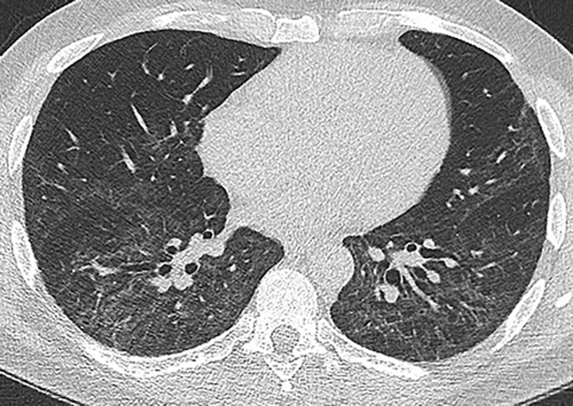 Patients With Long-ϹΟVΙD Show Abnormal Lung Perfusion Despite Normal CT Scans