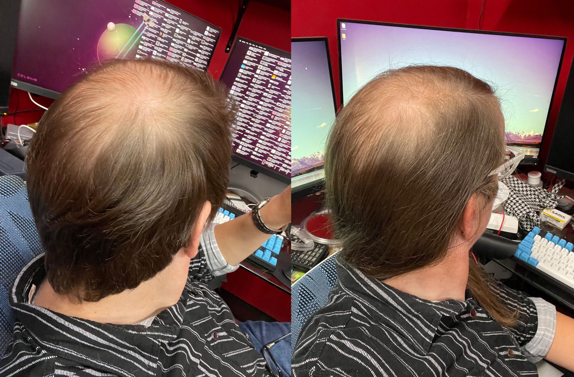 Cailín's hair between June of 2021 and September of 2024. The visible thinness is getting less visibly thin over time.