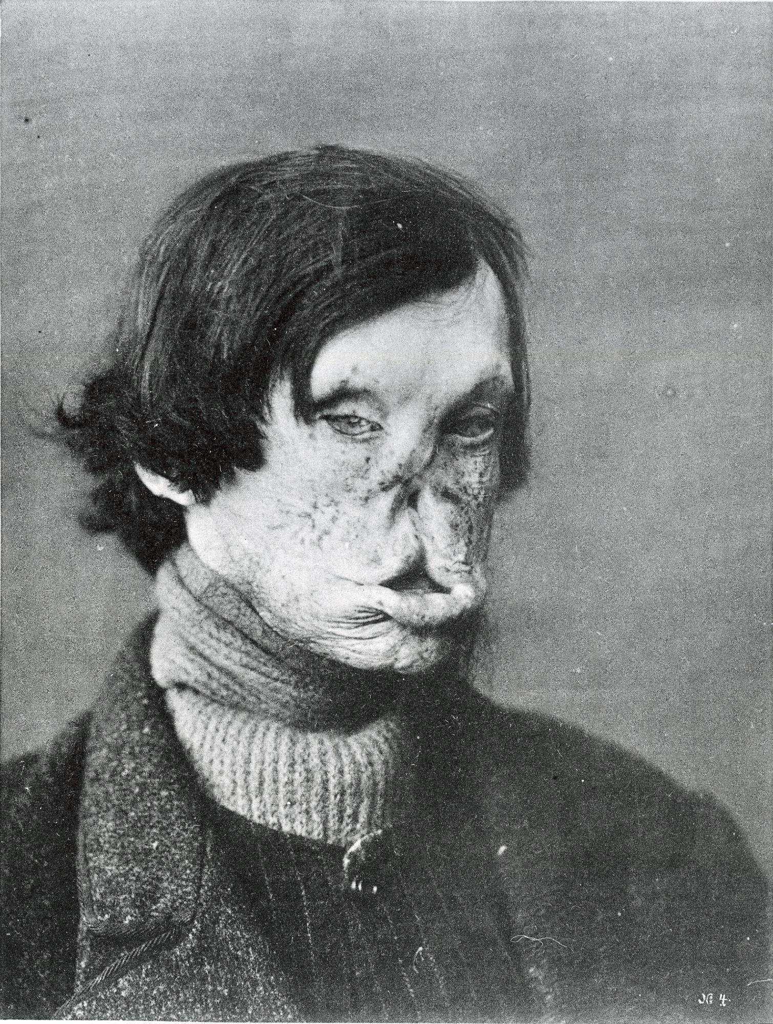 
Tuberous Leprosy
Description	
LEPROSY: Patient with tuberous leprosy.
This file comes from the Wellcome Collection, a website operated by Wellcome Trust, a global charitable foundation based in the United Kingdom.
https://wellcomecollection.org/works/n9sqqkra?wellcomeImagesUrl=/indexplus/image/L0032810.html


Extracted from Leprosy In Its Clinical & Pathological Aspects by G. Armauer Hansen and Carl Looft, Wright and Co, Bristol, 1895, Plate III.

Keywords: Patients; PATIENT; Leprosy; 19th century