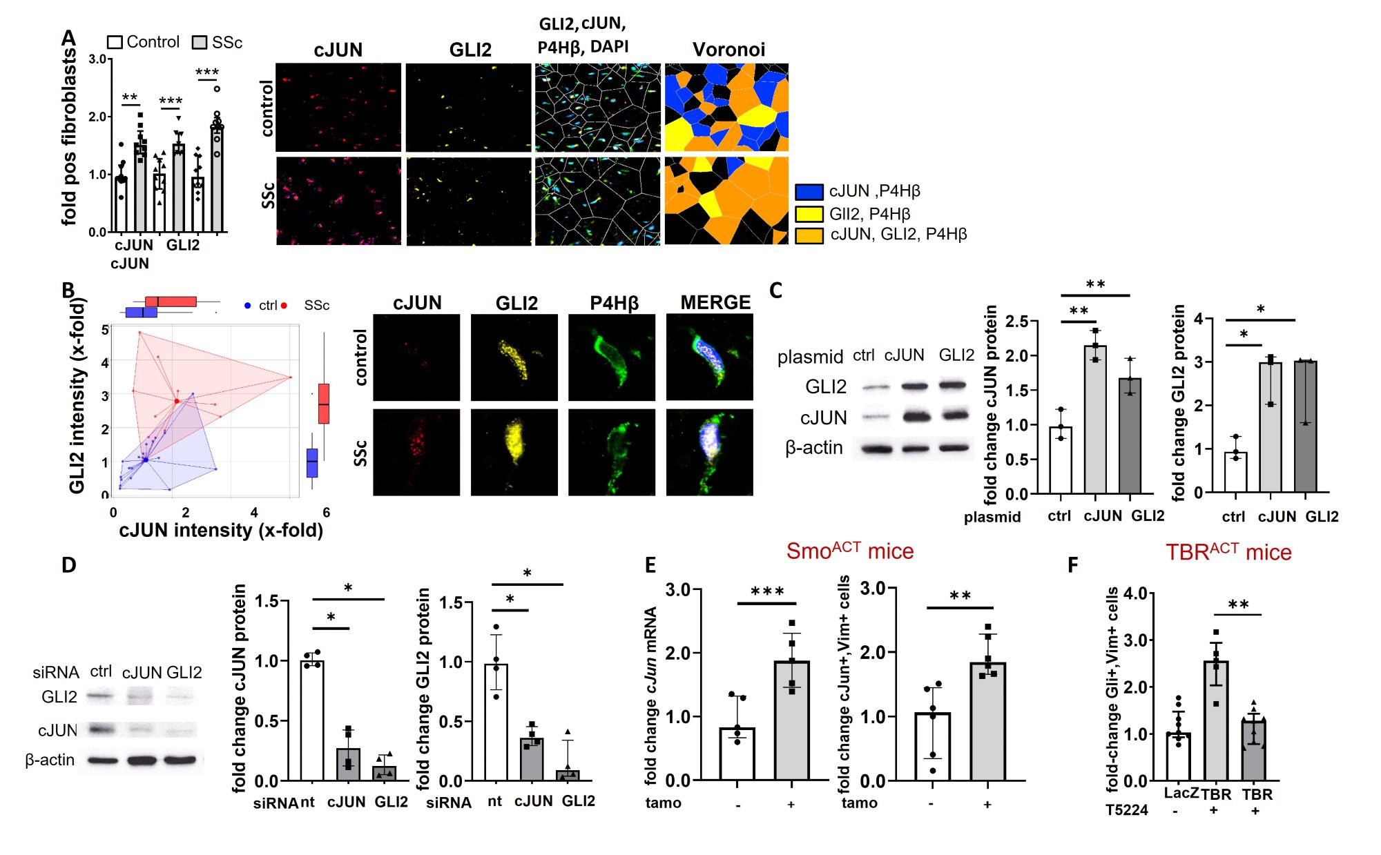 Figure 1: cJUN and GLI2 are concomitantly overexpressed in SSc and induce their mutual expression
A: Concomitant upregulation of cJUN and GLI2 in lesional fibroblasts in SSc versus healthy subjects. Representative images of immunofluorescence staining for cJUN (red), GLI2 (yel-low) and co-staining with P4Hβ (green) and DAPI (blue) in the dermis of healthy donors (n=5) and dcSSc (n=5) patients at 1000-fold magnification. Voronoi diagrams and quantifi-cation of cJUN positive fibroblasts, GLI2 positive fibroblasts and cJUN; GLI2 double posi-tive fibroblasts are included as bar graphs. B: Representative fibroblast at 10,000-fold mag-nification using confocal microscopy. Quantification: Dots represent individual cells from a total of 4 patients and 4 controls. C/D: Mutual regulation of expression levels of cJUN and GLI2 in fibroblasts upon overexpression (C) or knockdown by siRNA (D) (n= 3 per group). E: Increased expression of cJUN in SmoACT mice compared to control mice on mRNA and protei