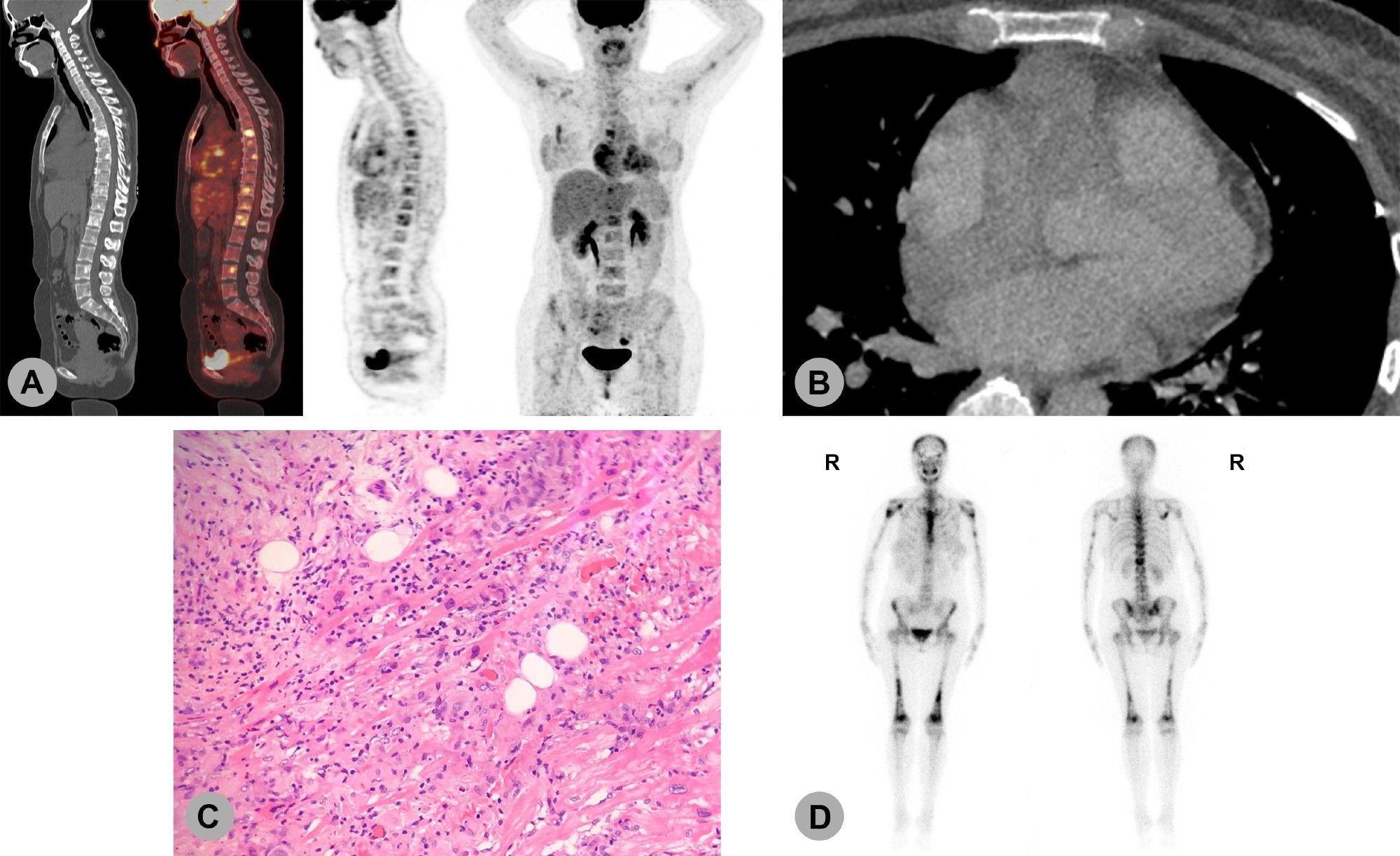 A, 18F-PET/CT showed hypermetabolic activity on vertebrae, sternum, pelvis, scapula, humerus and femur, and revealed mild pericardial effusion
B, Cardiac CT after pericardiocentesis revealed a mass invading the right atrium
C, Pathologic studies after an open surgery revealed the deposition of “foamy” histocytes surrounded by inflammatory cells
D, Bone scintigraphy showed radioactive concentration of bilateral distal femurs