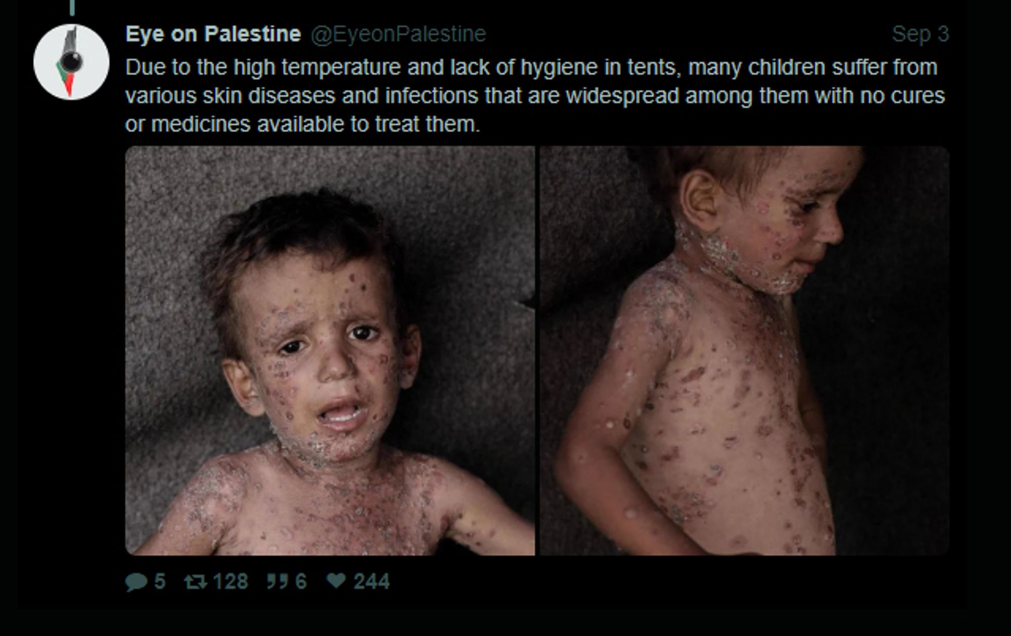 Screenshot of a tweet from user @EyeonPalestine:

"Due to the high temperature and lack of hygiene in tents, many children suffer from various skin diseases and infections that are widespread among them with no cures or medicines available to treat them."

The tweet has two photos attached to it. Different angles of a little boy, without a shirt, skin covered in rashes in various colors and expression of dispair on his face.