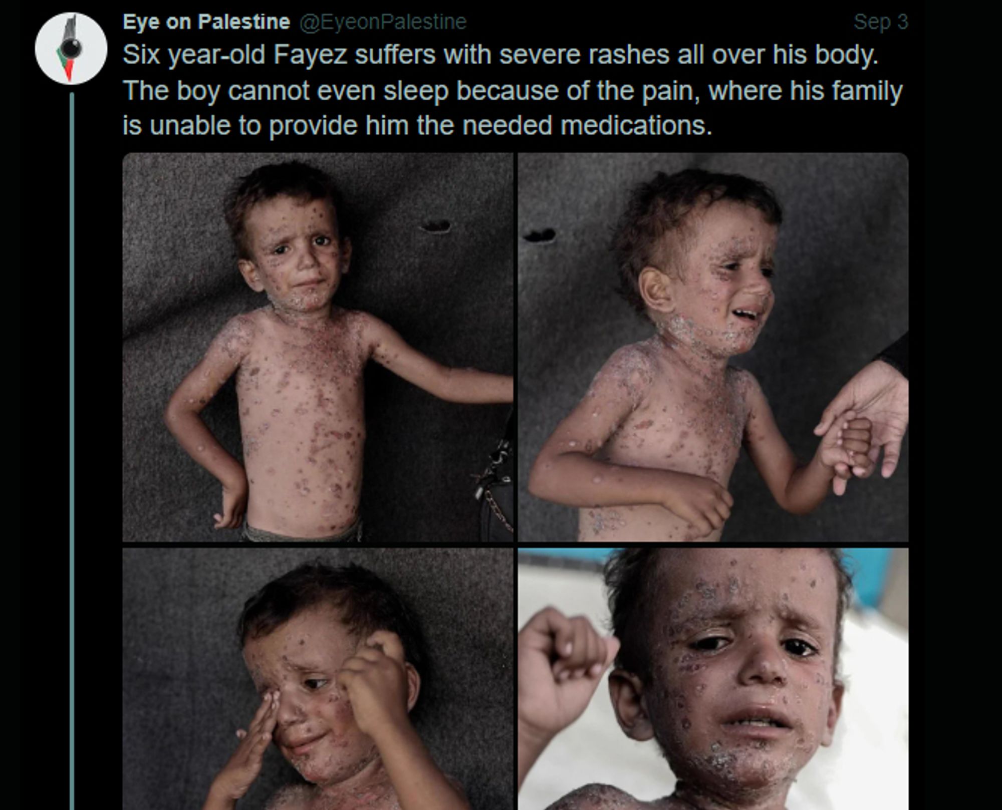 Screenshot of a tweet from user @EyeonPalestine:

"Six year-old Fayez suffers with severe rashes all over his body. The boy cannot even sleep because of the pain, where his family is unable to provide him the needed medications."

The tweet has four photos attached to it. Different angles of a little boy, without a shirt, skin covered in rashes in various colors and expression of dispair on his face.