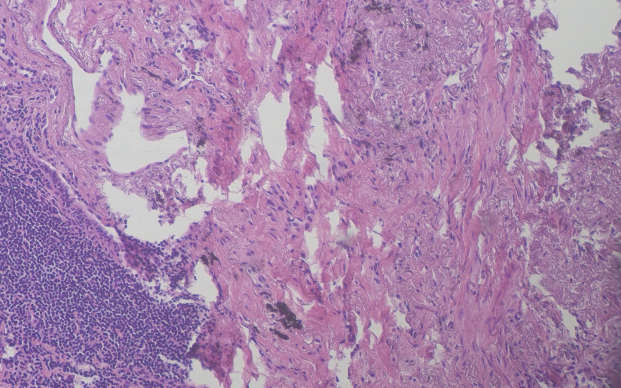 Paraffin section HE 100x: Inflammation and fibrosis.