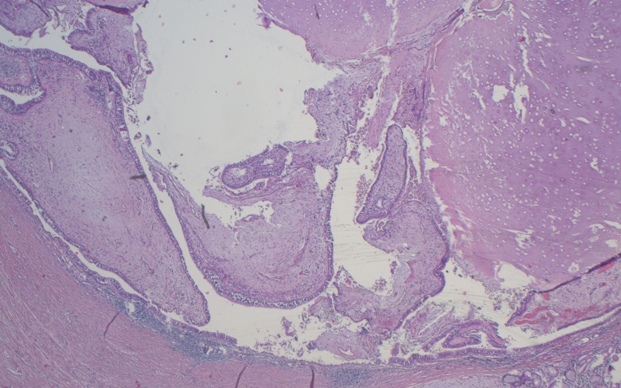 HE 40x: Chondrohamartoma occluding the bronchus of the lingula.