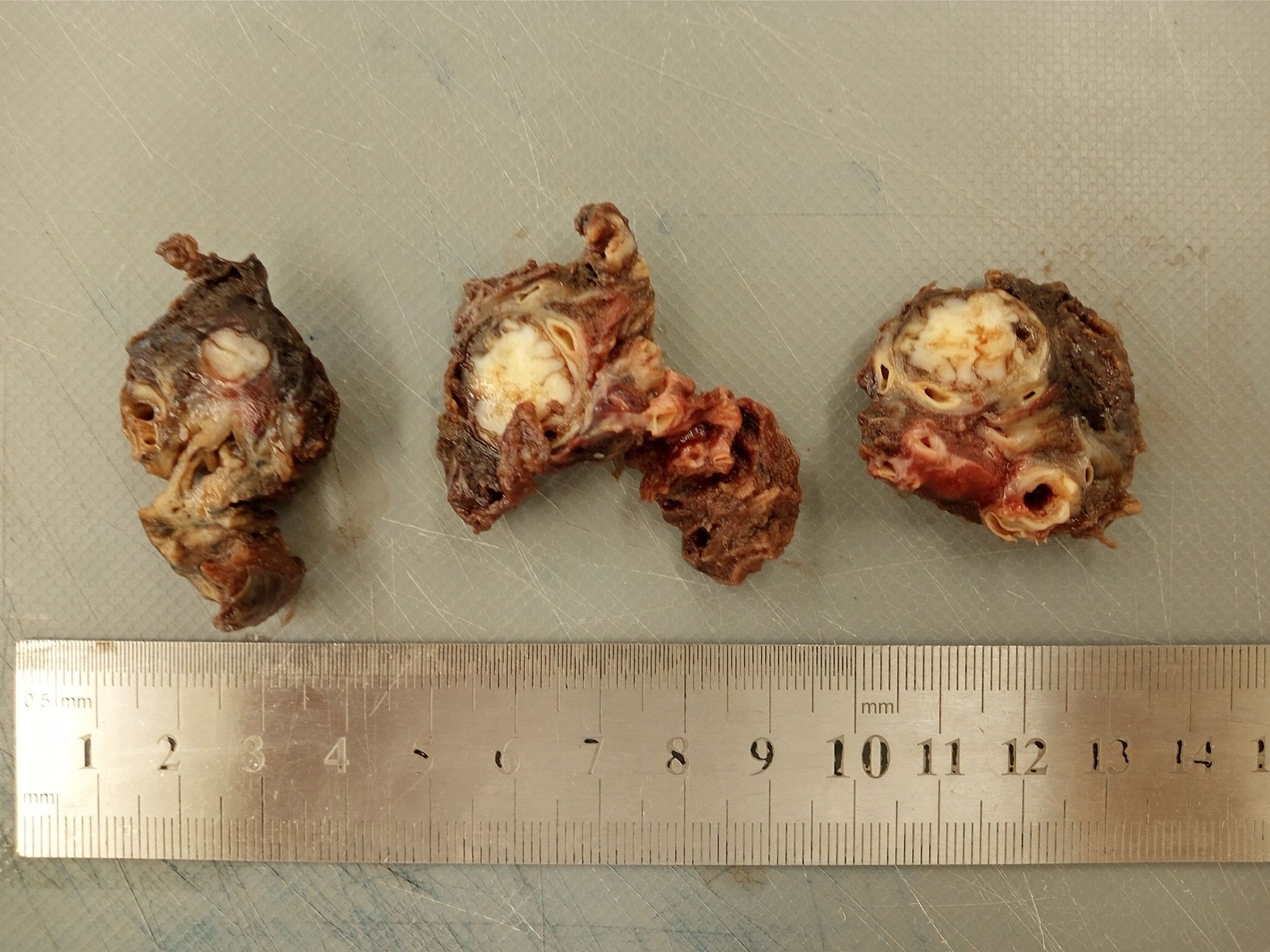 Inside the bronchus we found a cartilaginous tumor.