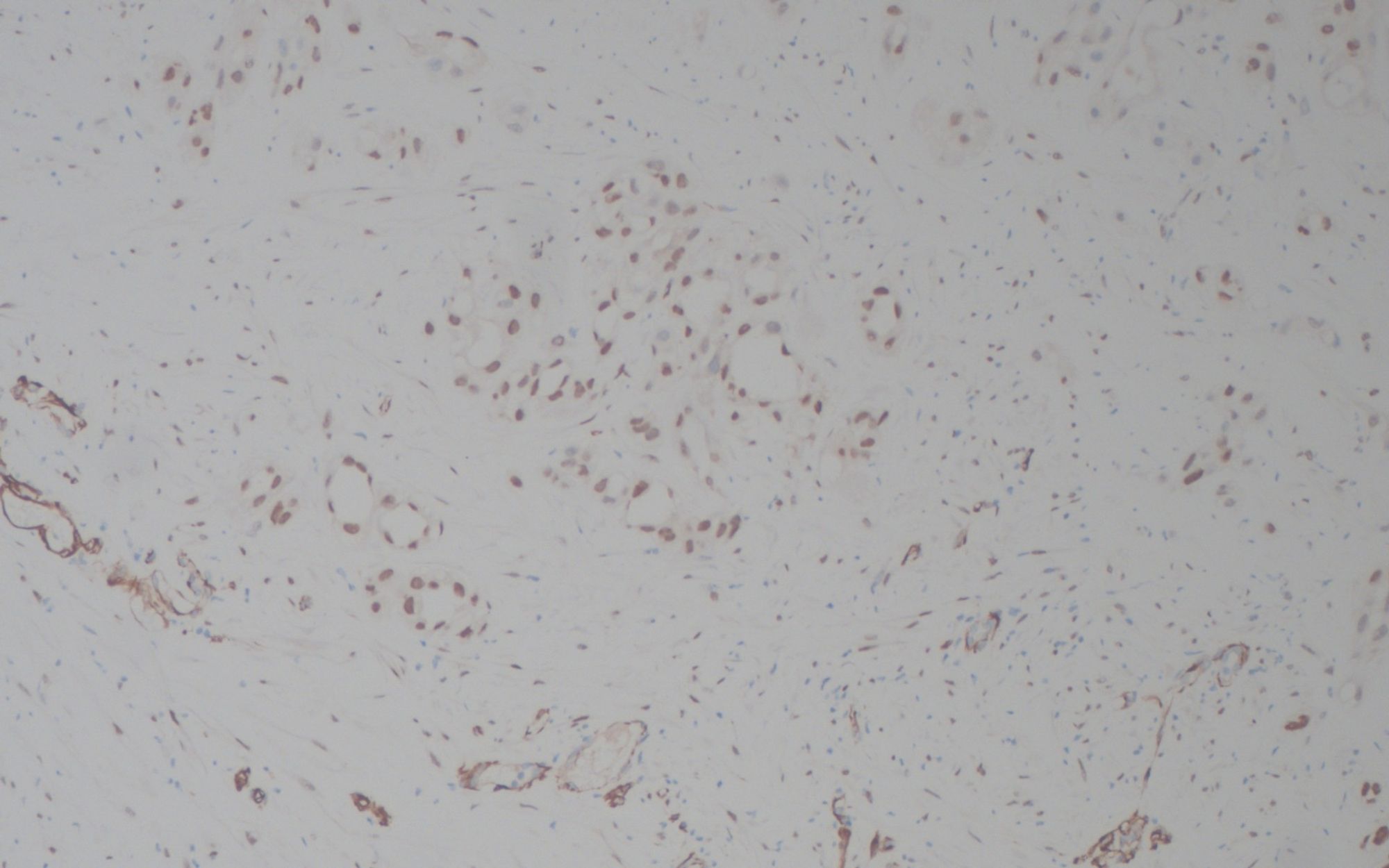 WT-1 IHC 100x