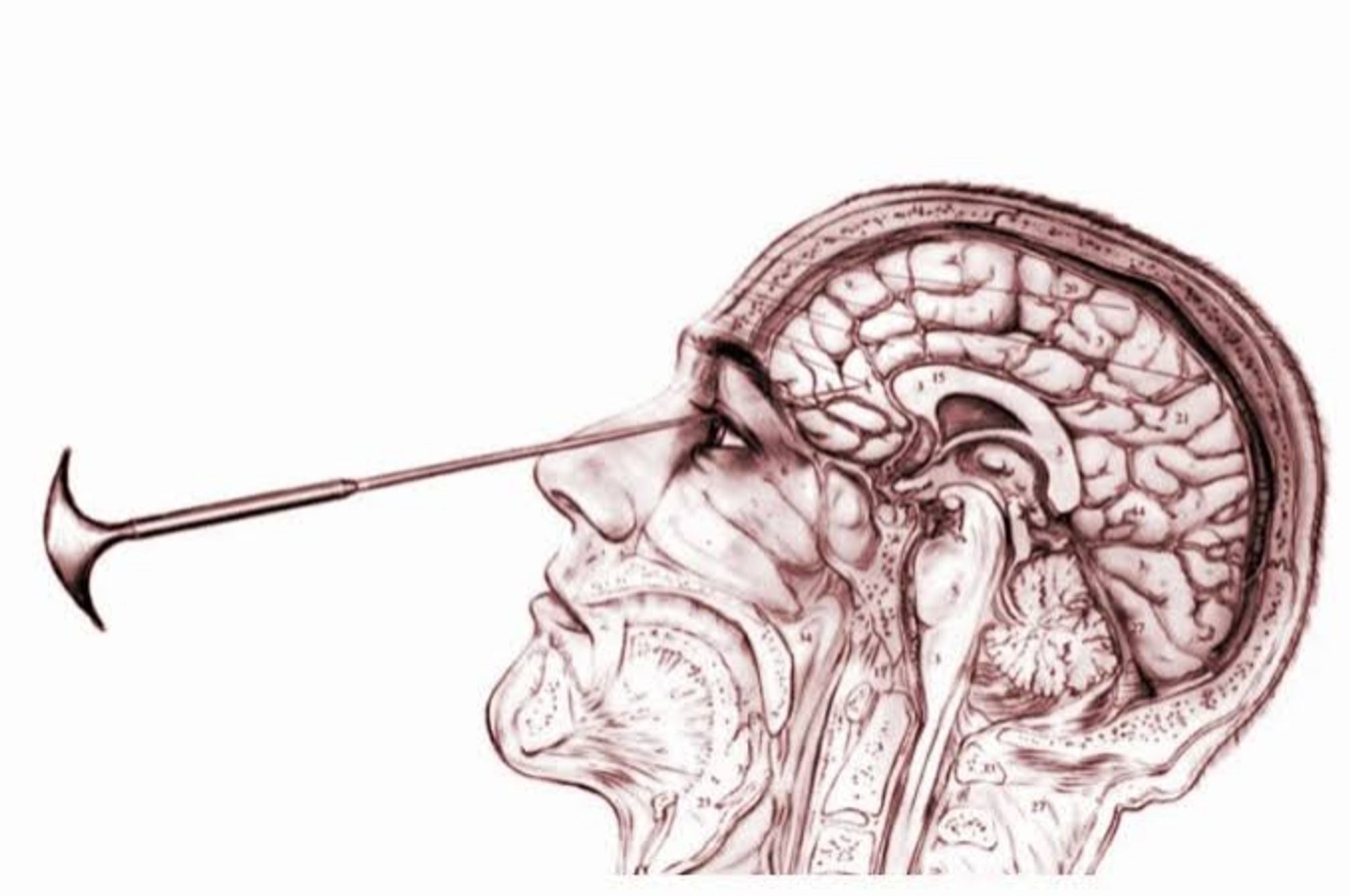 Ilustração de lobotomia