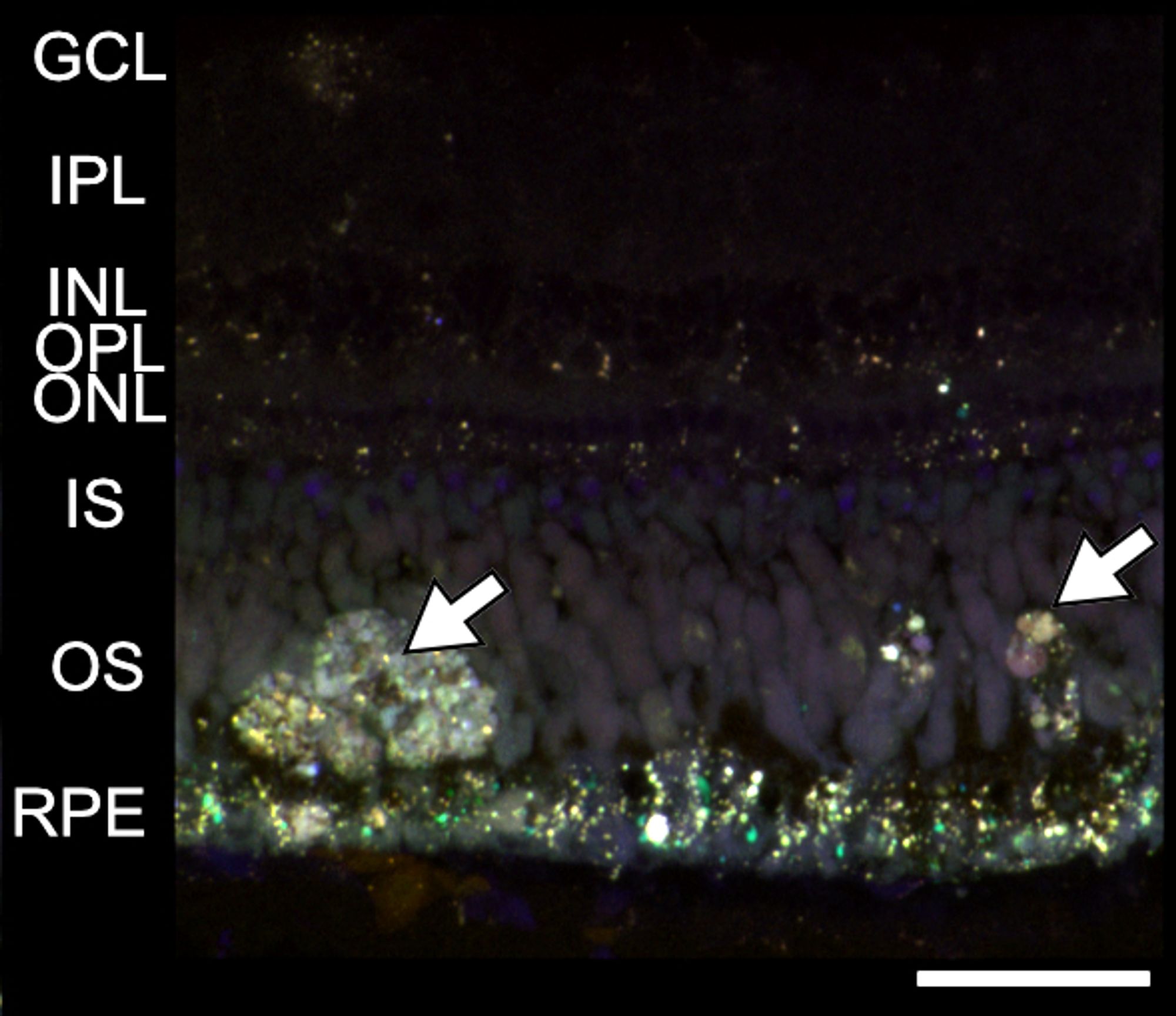 Large autofluorescent deposits (yellow, white arrows) in the outer segment/subretinal layer. In humans, deposits such as this are associated with advanced age-related macular degeneration and progression to blindness. Scale bar = 50 um.