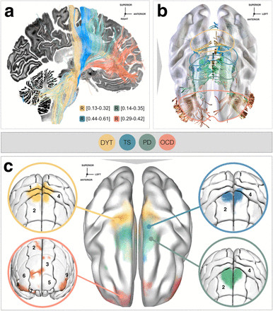 Figure from Hollunder & al. 2023 (preprint) - Functional gradient of fiber tracts and their cortical projection sites associated with therapeutic stimulation effects.