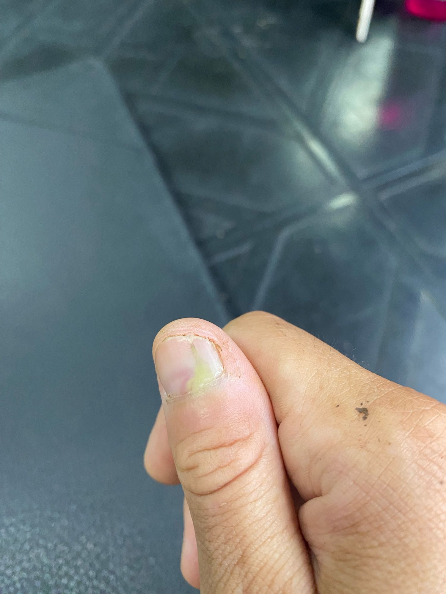 Photo of my right thumb showing some green puss(?) under the nail