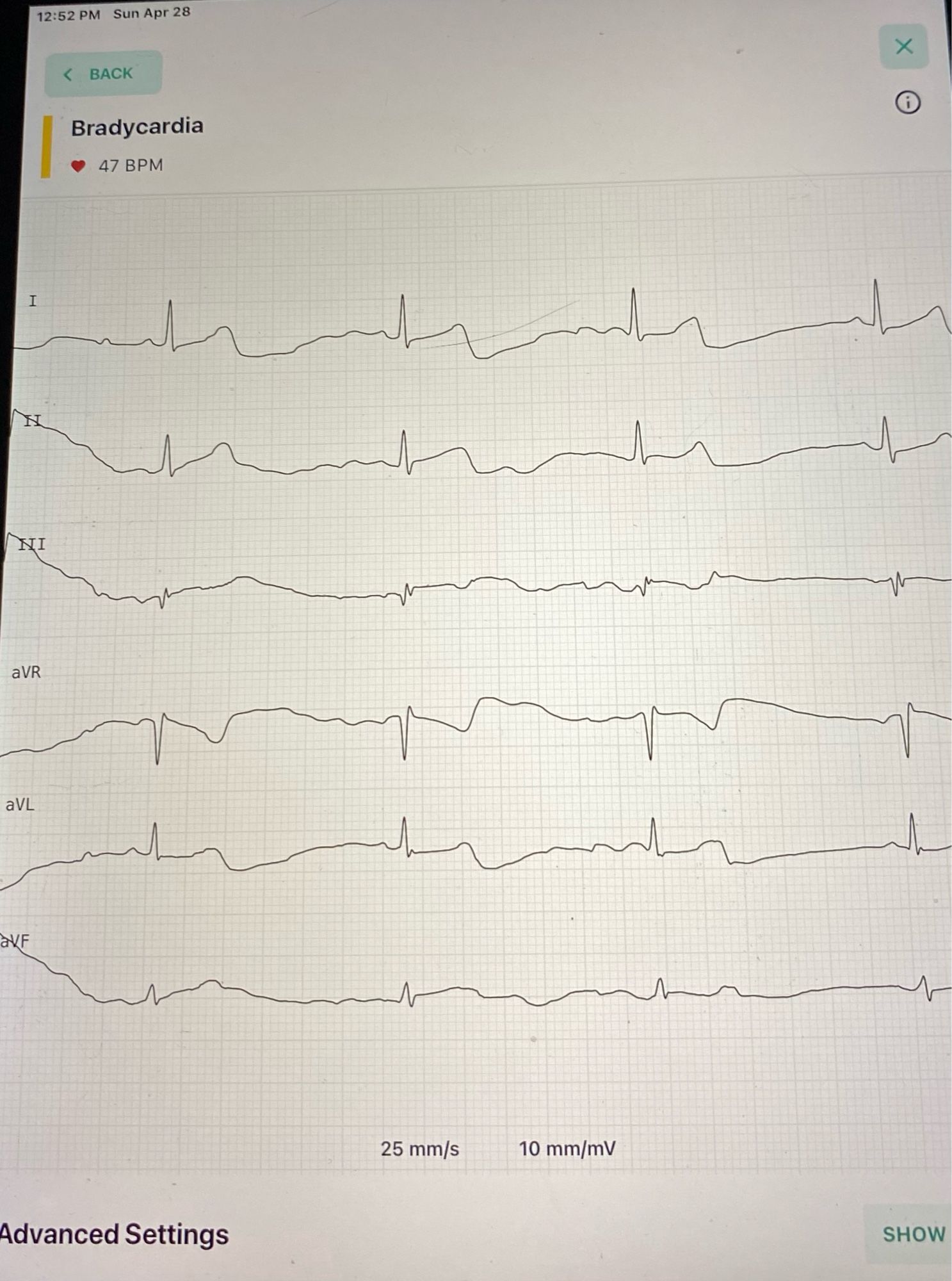 My Photo: 6-line EKG showing low BPM (mis)interpreted as Bradycardia

#KnowYourNumbers