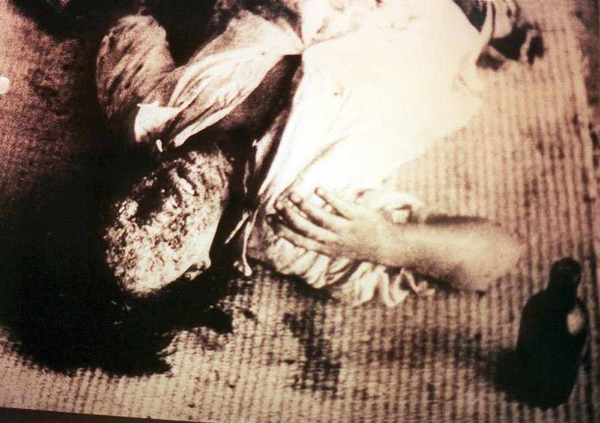 A black and white photograph of one of the victims of the Little Boy atomic bomb lying on a mat on the floor. It is unclear whether the victim is a man or a woman because most of the skin on the face has been horribly burned and melted, as have the eyes.