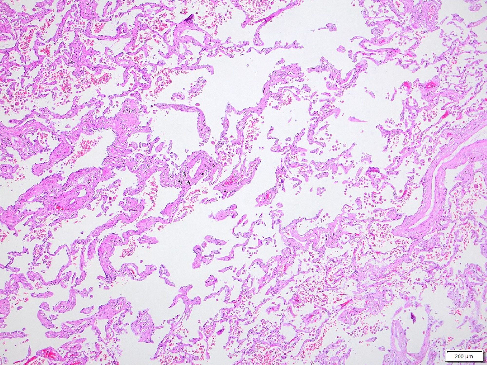 Alveolar tissue is reduced and lung shows fibrosis. This is SRIF (smoking related intertitial fibrosis)